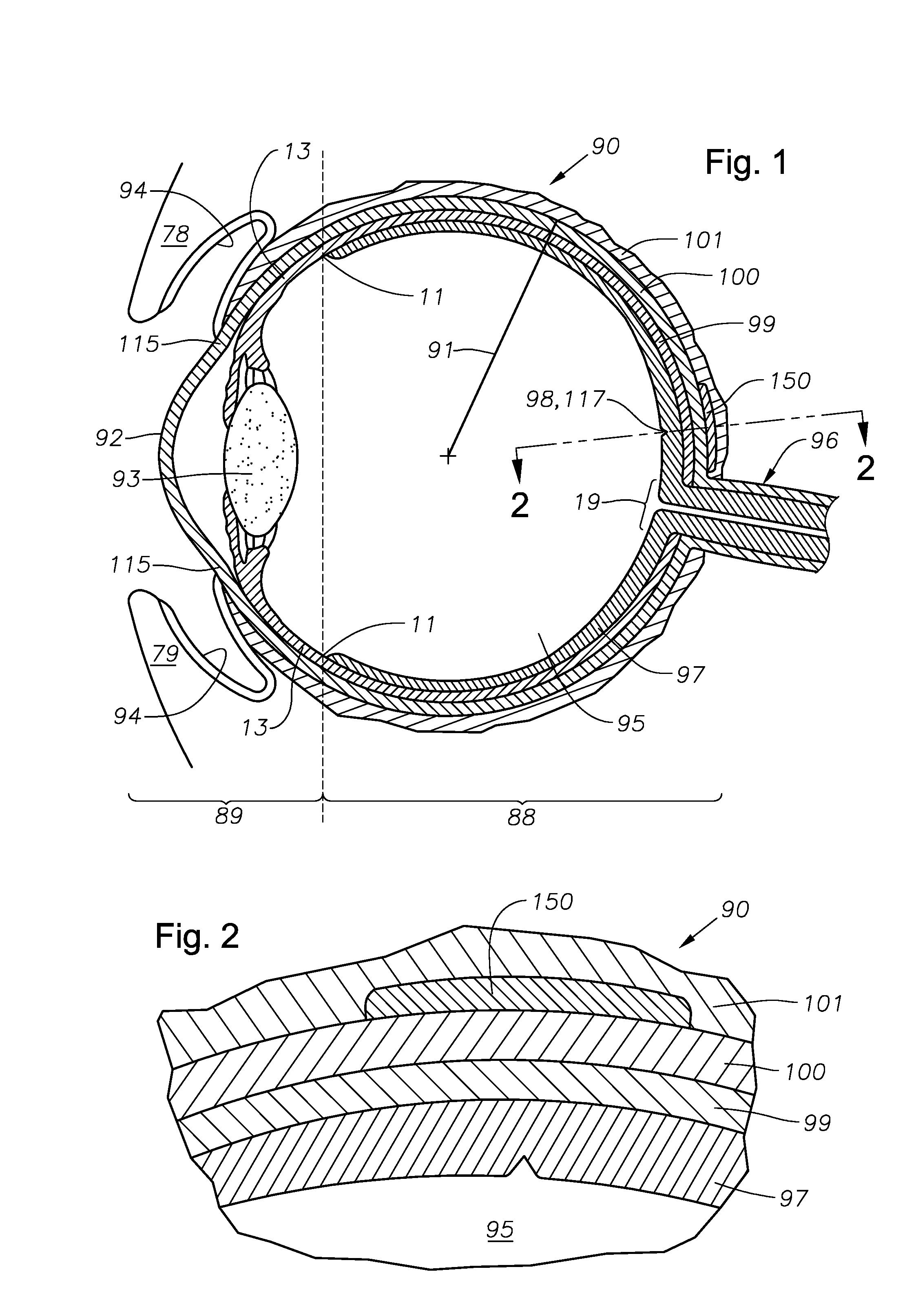 Juxtascleral Drug Delivery and Ocular Implant System