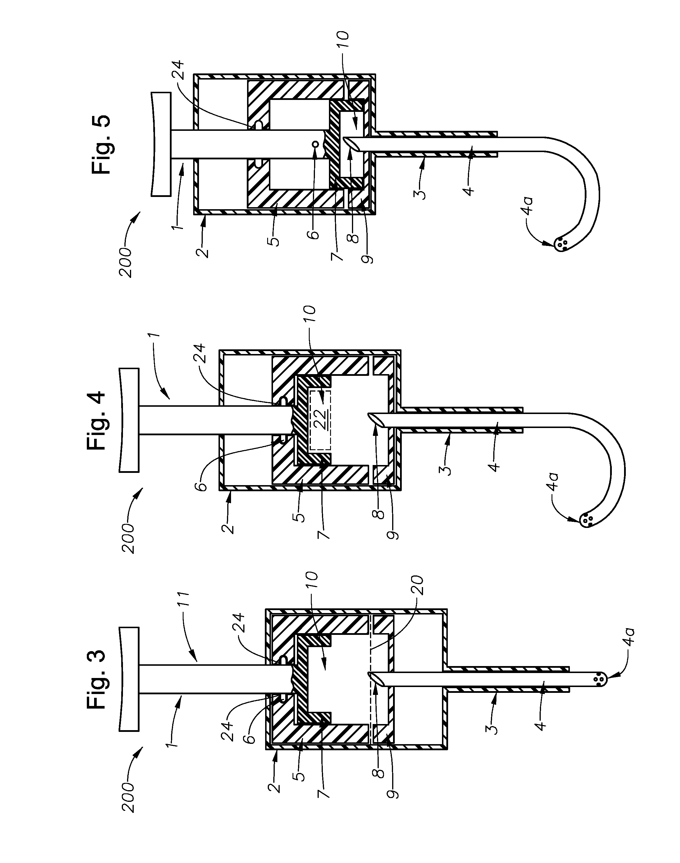 Juxtascleral Drug Delivery and Ocular Implant System