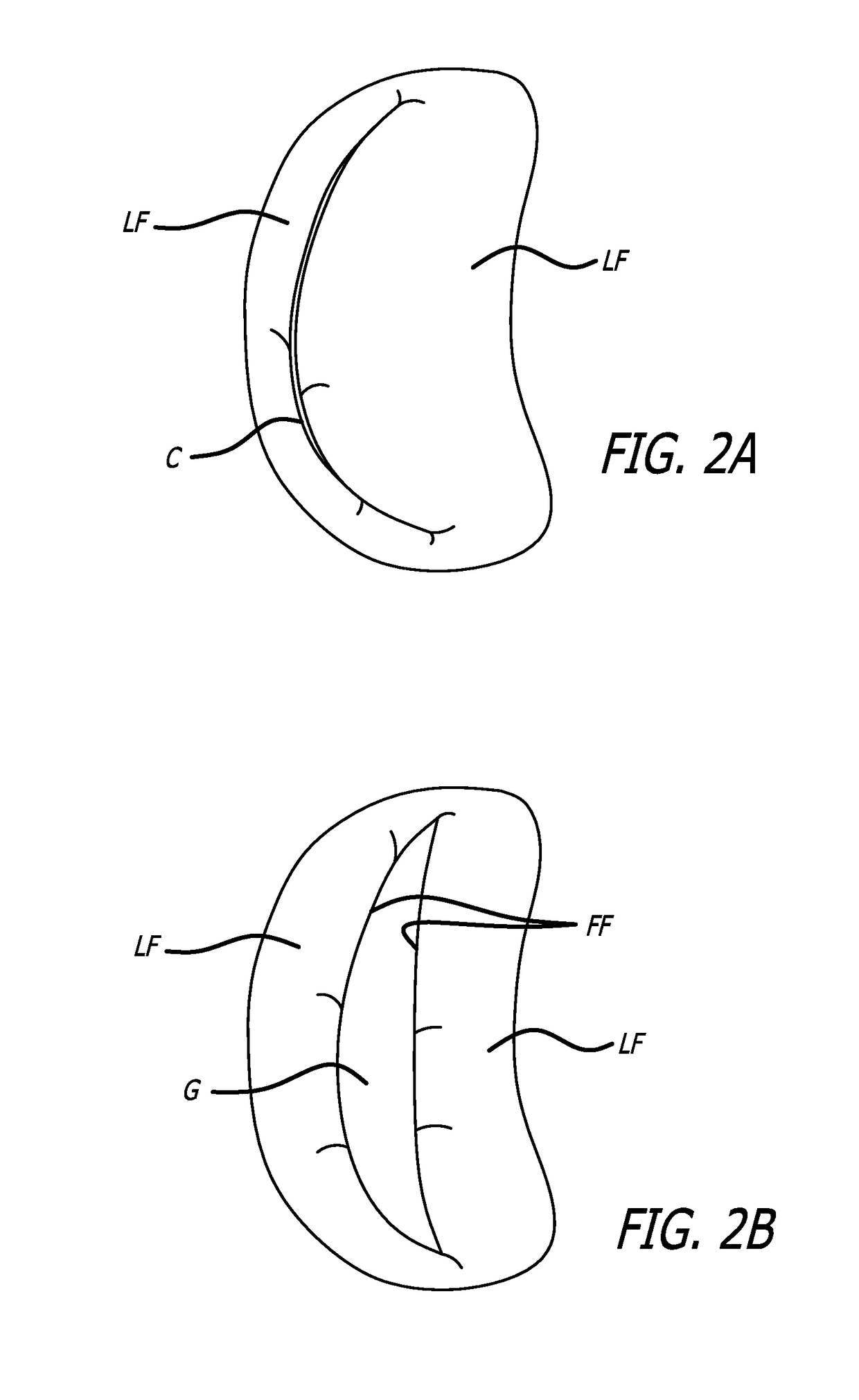 Double basket assembly for valve repair