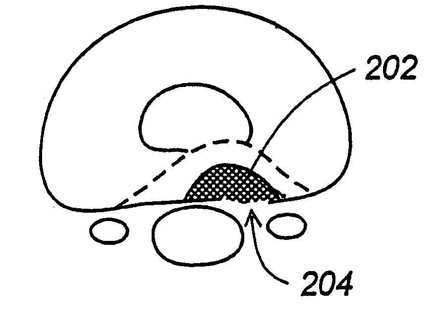 Methods and apparatus for treating disc herniation and preventing the extrusion of interbody bone graft