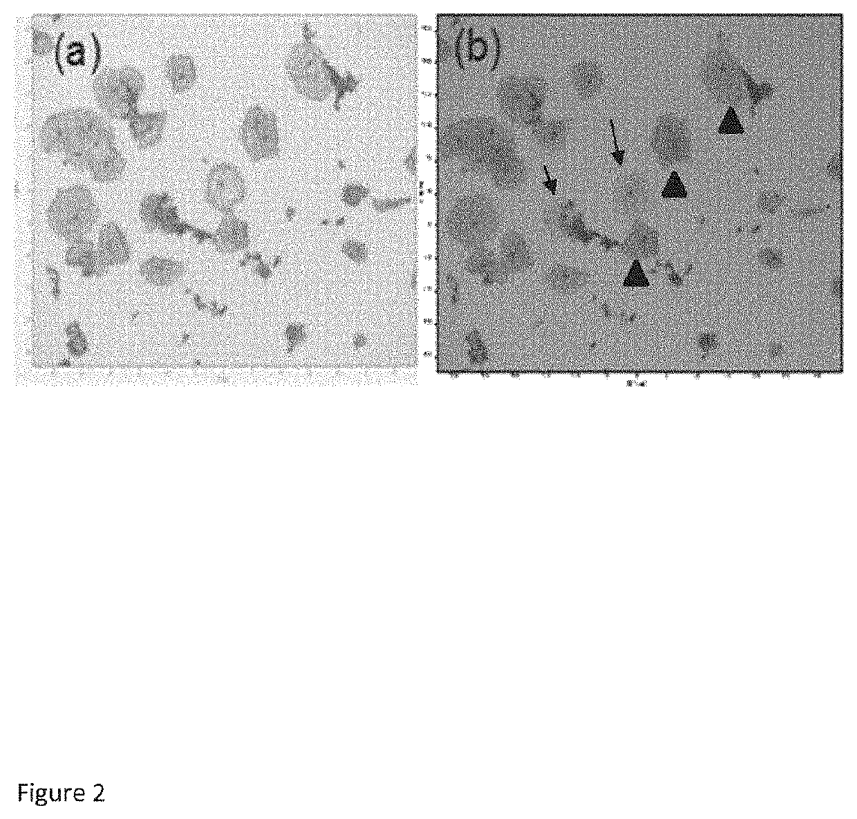 A method for identification of low grade cervical cytology cases likely to progress to high grade/cancer