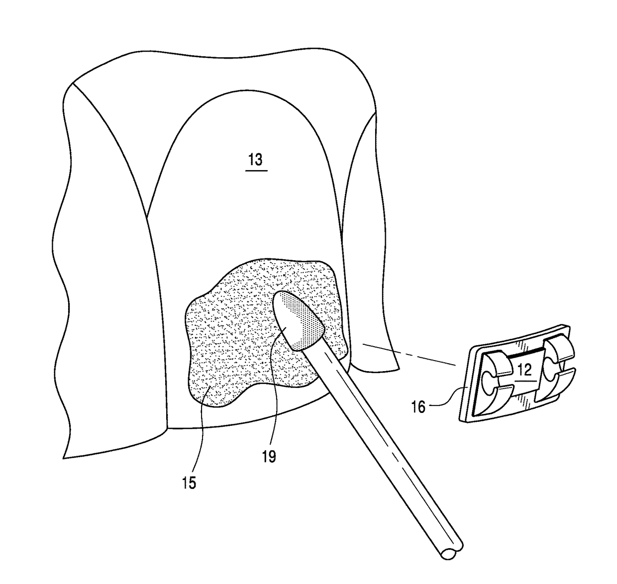 Adjustable orthodontic bracket and method using a microstructured shape memory polymer surface with reversible dry adhesion