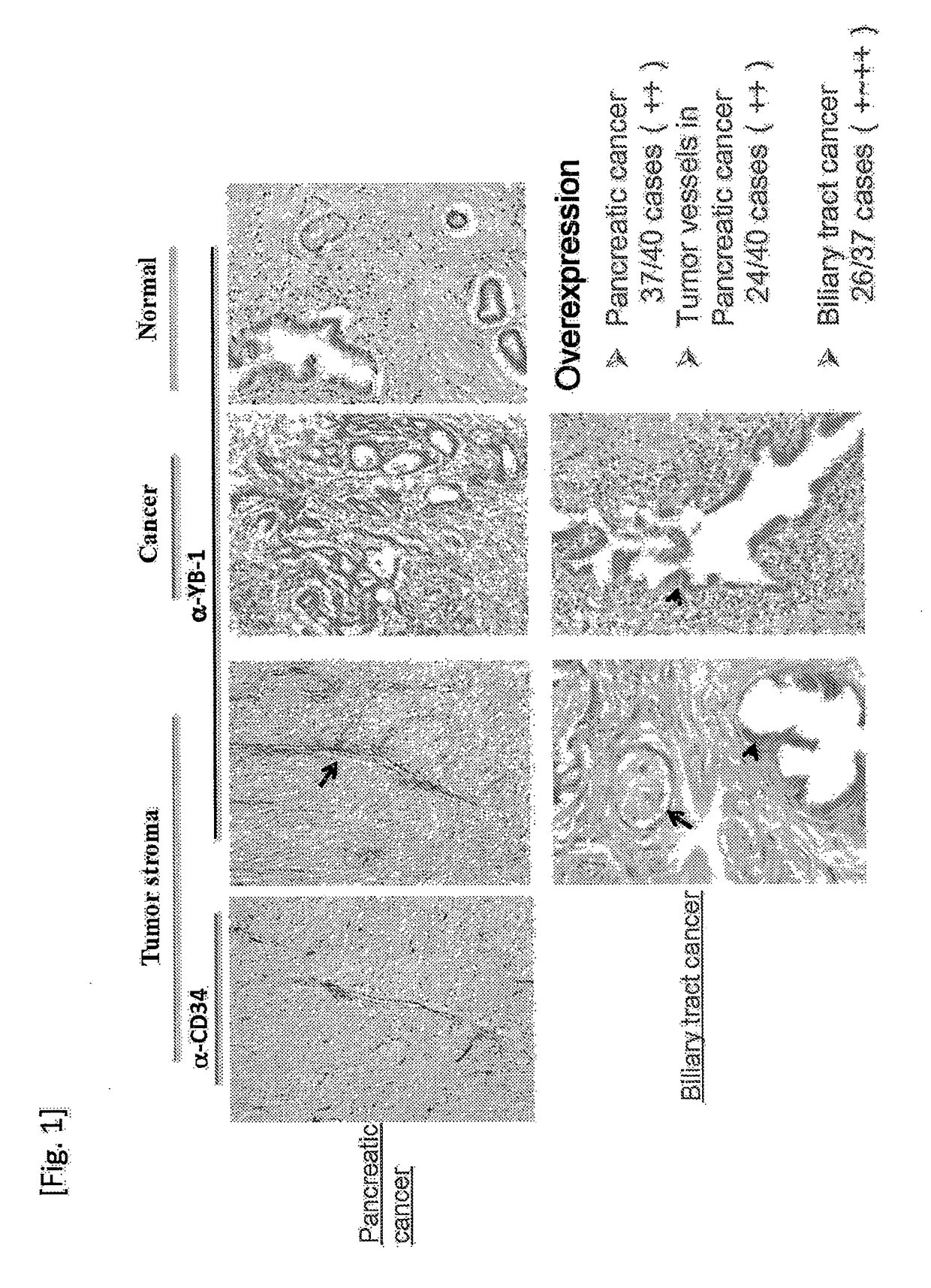 Antisense antineoplastic agent