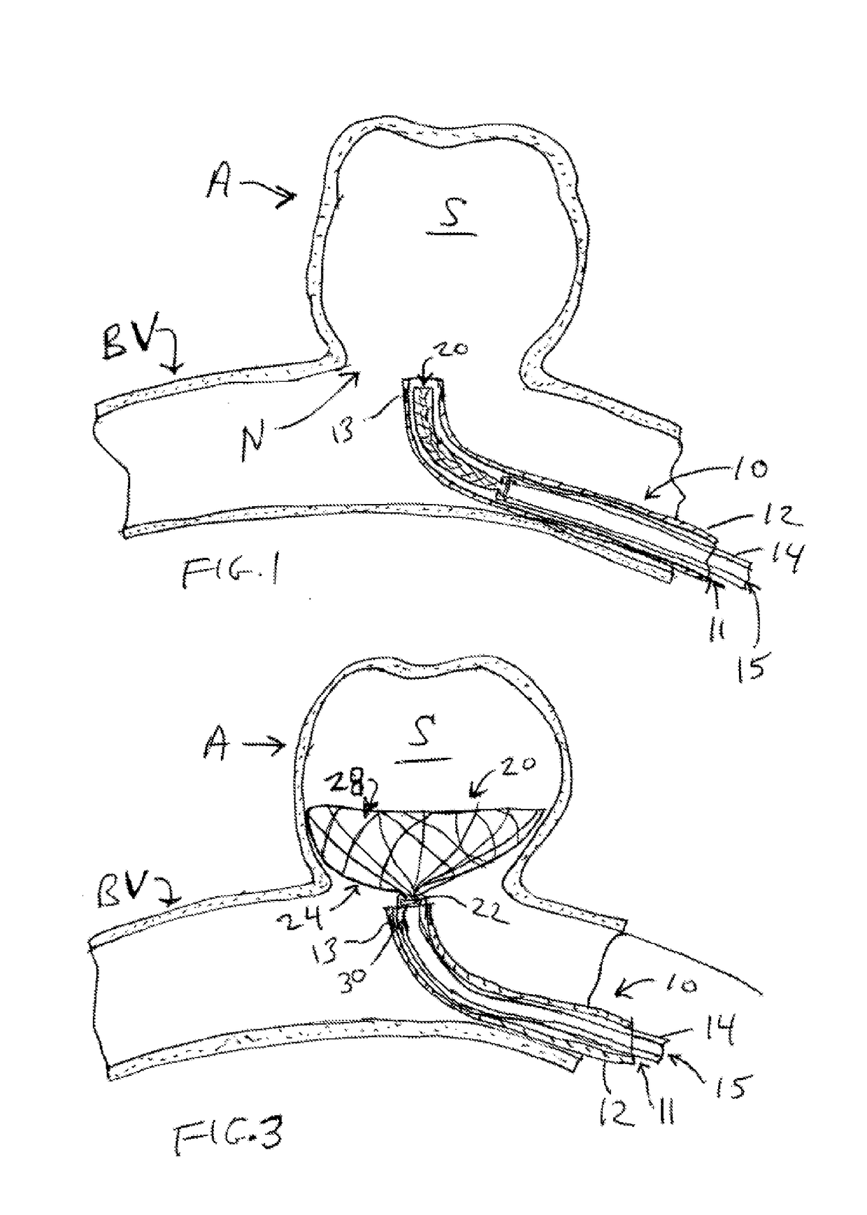 Aneurysm occlusion device