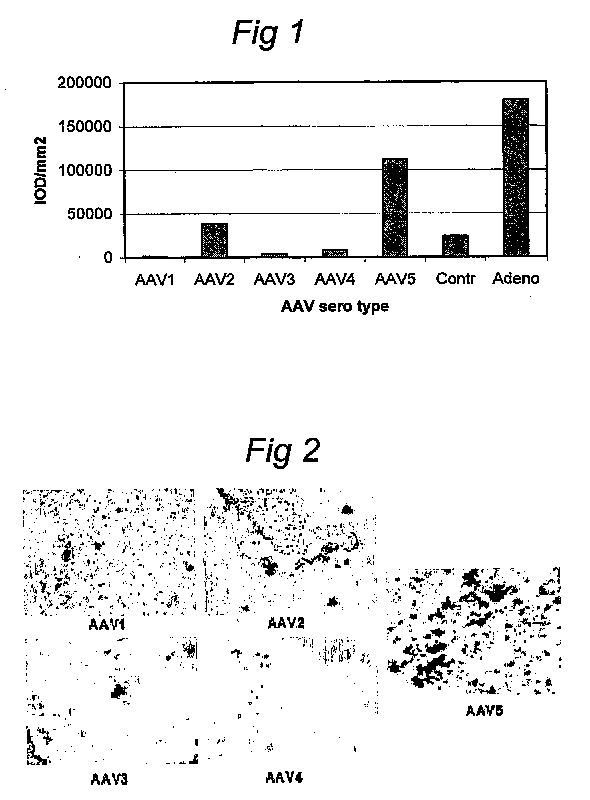 AAV vectors for in vivo gene therapy of rheumatoid arthritis