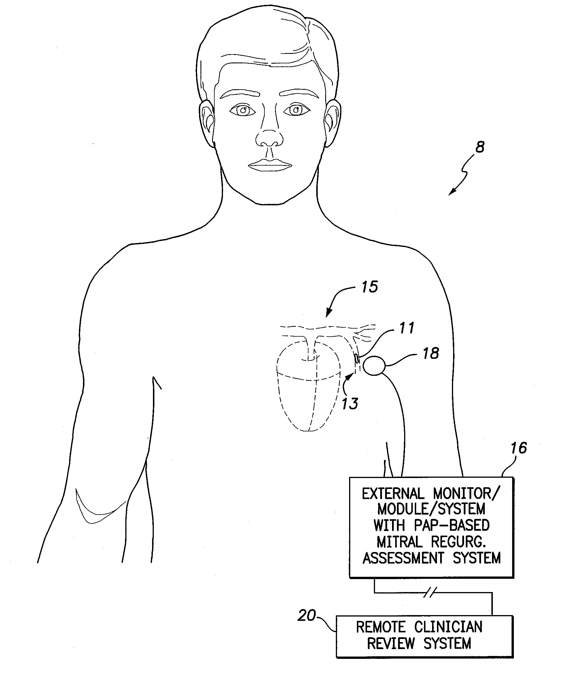 Systems and methods for using pulmonary artery pressure from an implantable sensor to detect mitral regurgitation and optimize pacing delays