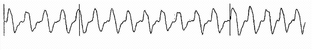 System And Method For Diagnosis And Treatment Of A Breathing Pattern Of A Patient