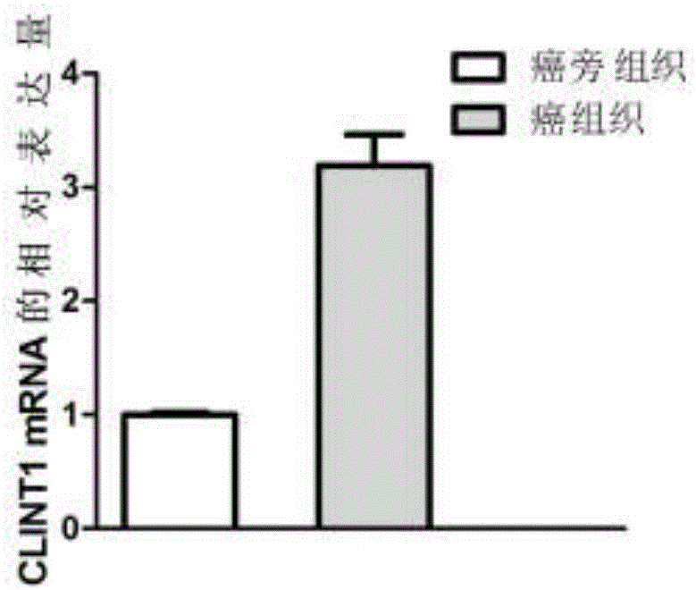 Application of biomarker as target to diagnosis and treatment of lung adenocarcinoma