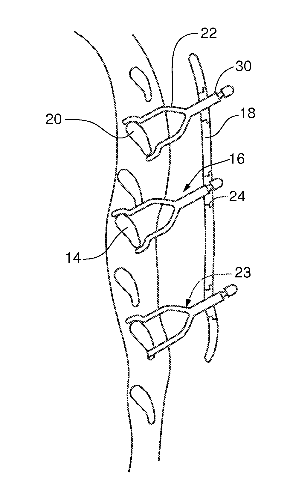 Device for treating flail chest