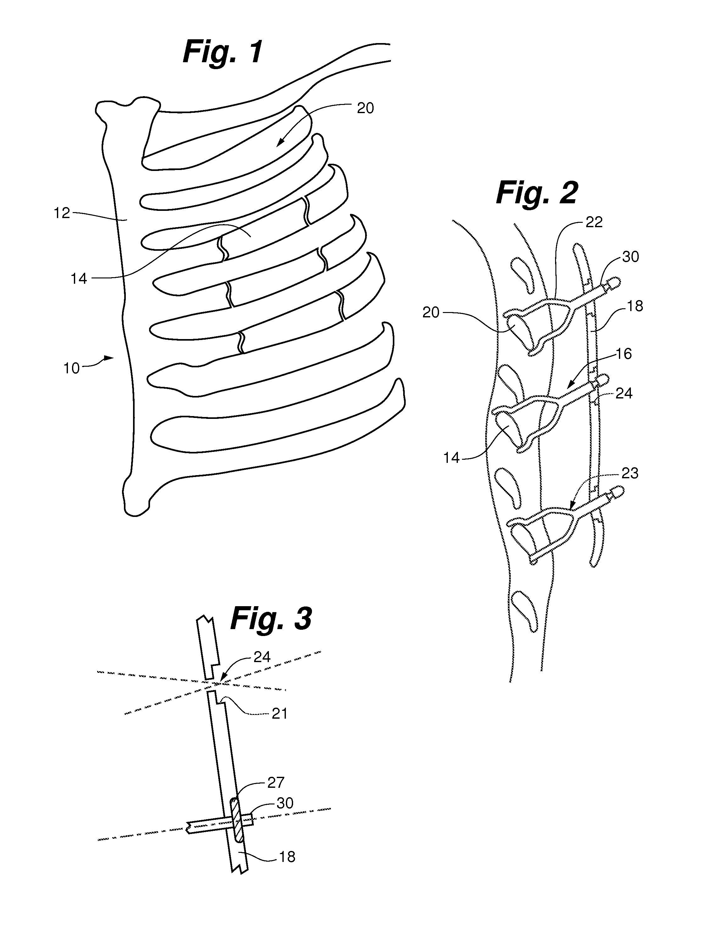 Device for treating flail chest