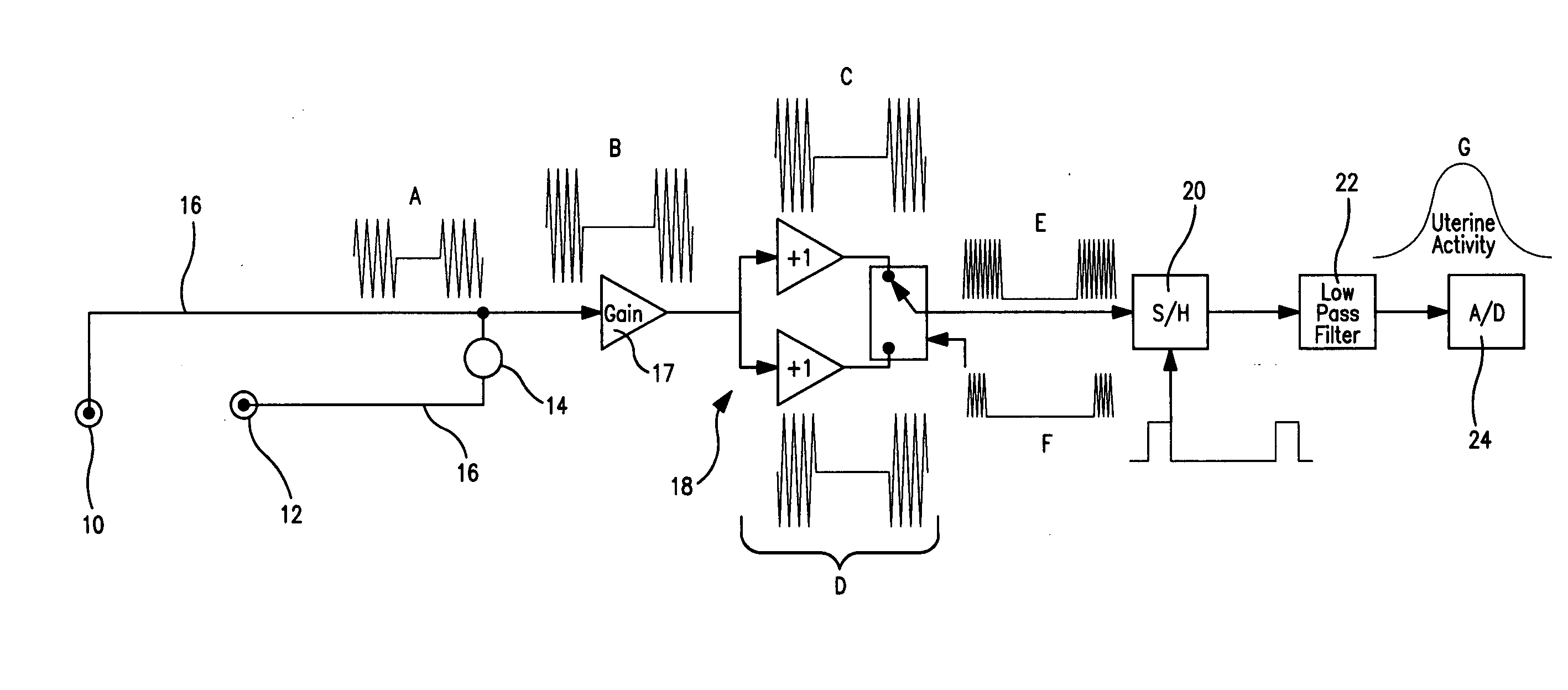 Uterine activity monitoring using impedance plethysmography