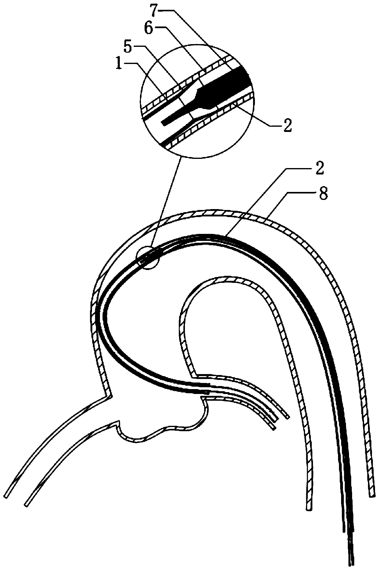 Guide prolonged catheter