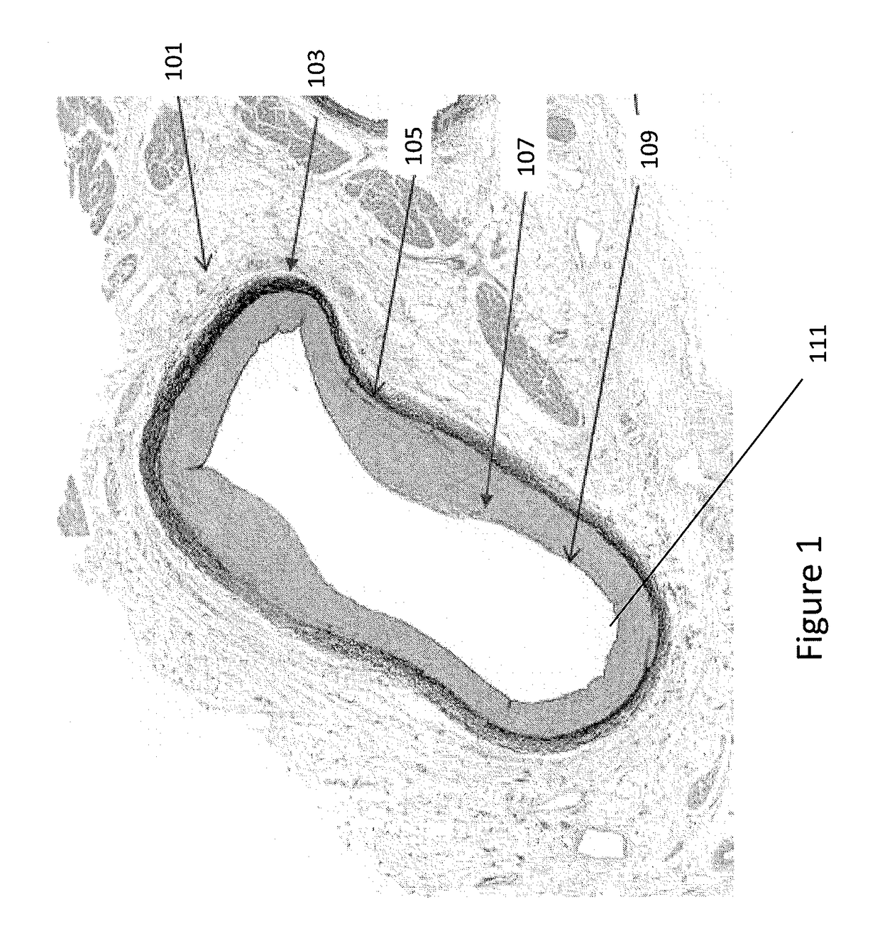 Identification of elastic lamina to guide interventional therapy