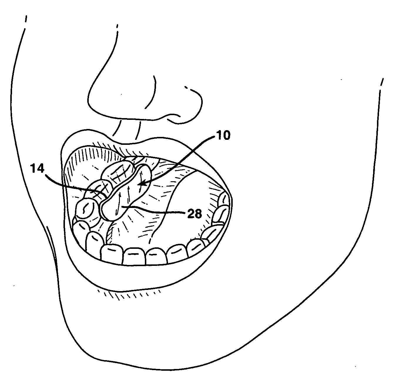 Intraoral illumination device