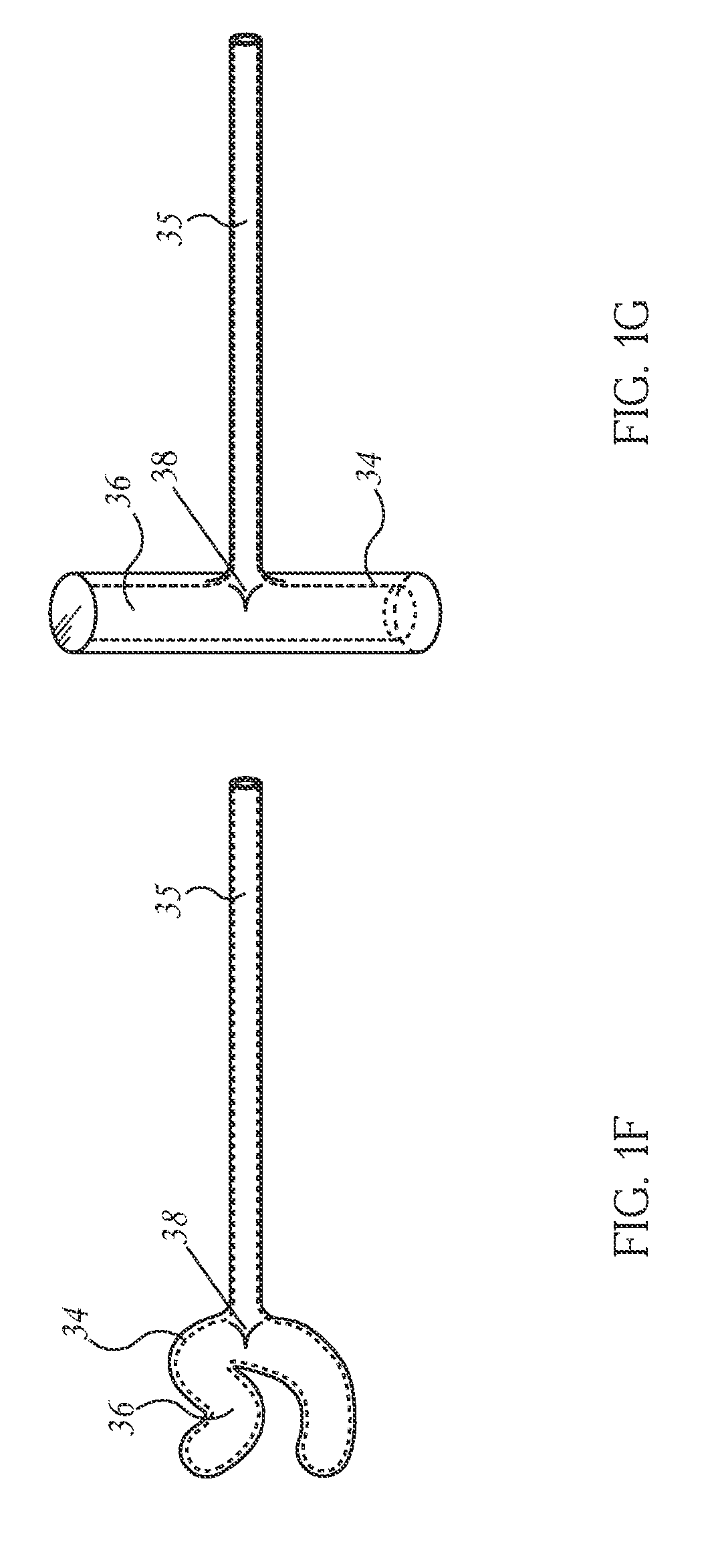 Closed Loop Gastric Restriction Devices and Methods