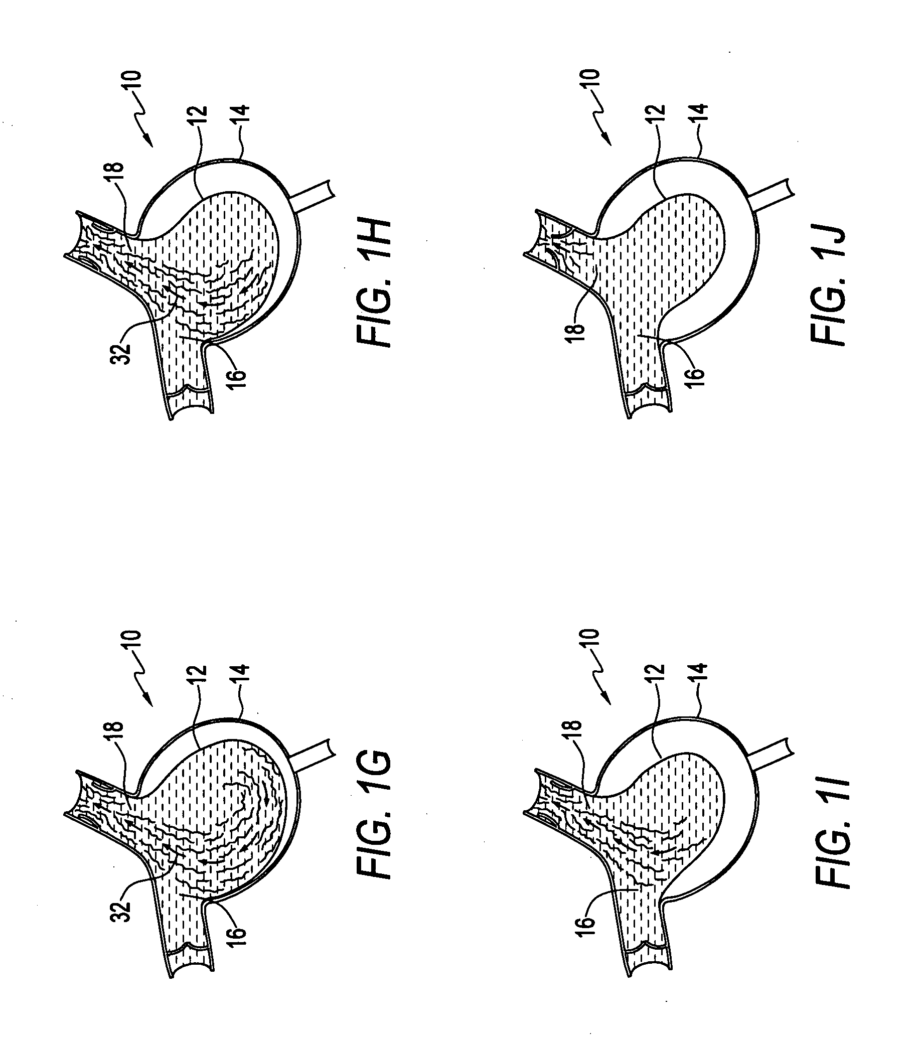 Method for making a blood pump and pumping blood