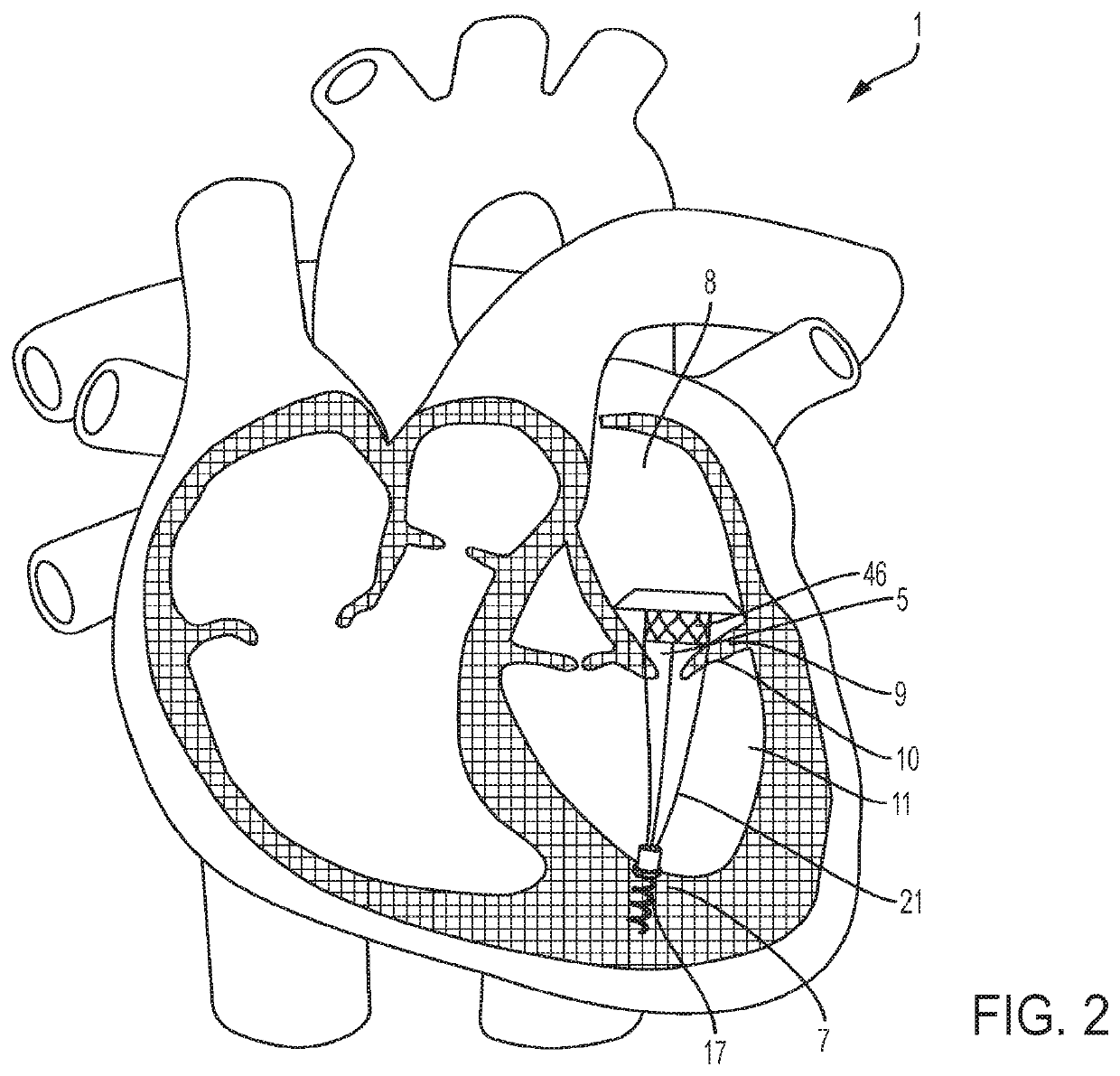 Transcatheter atrial anchors and methods of implantation