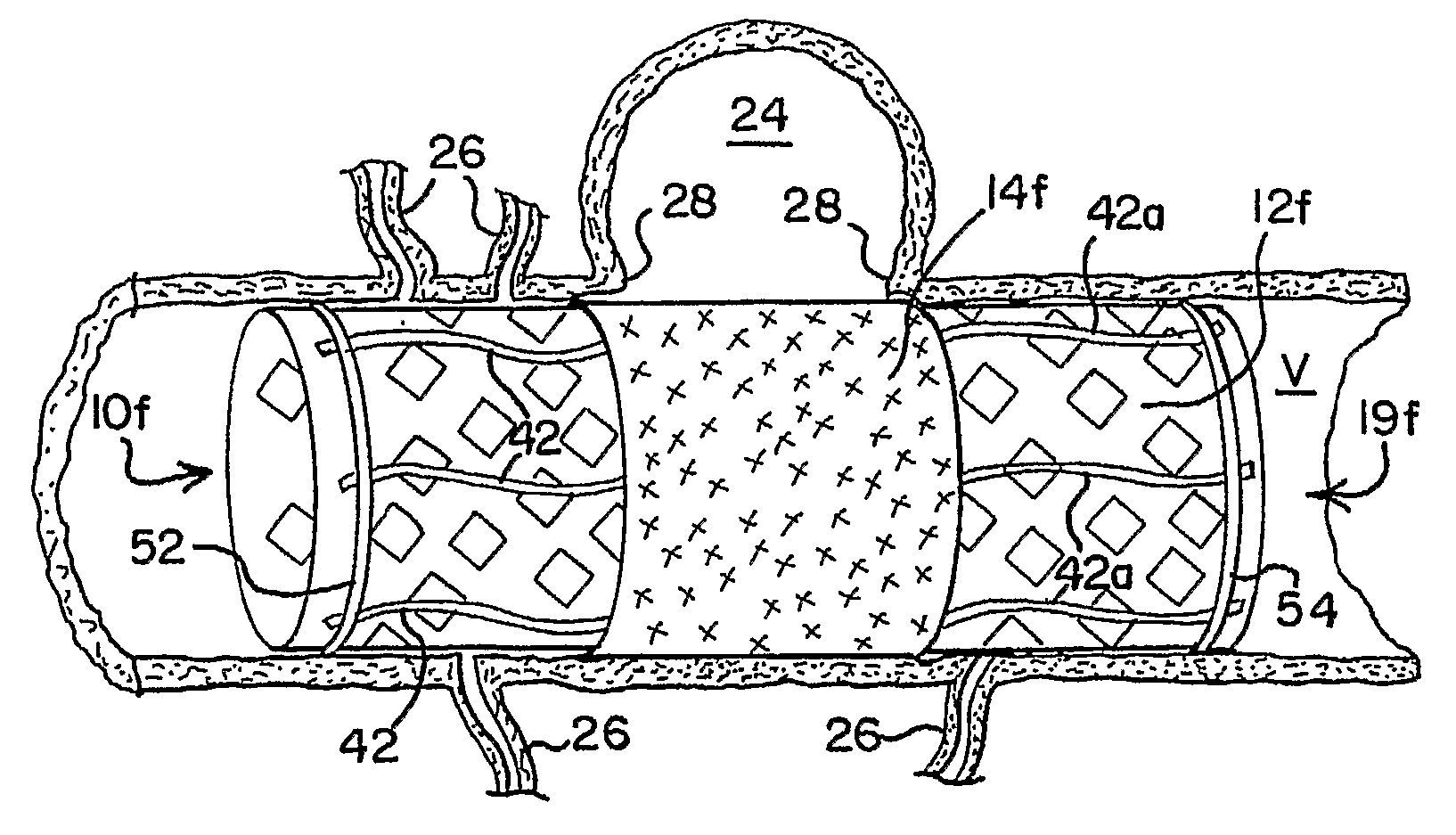 Thin Film Devices for Occlusion of a Vessel