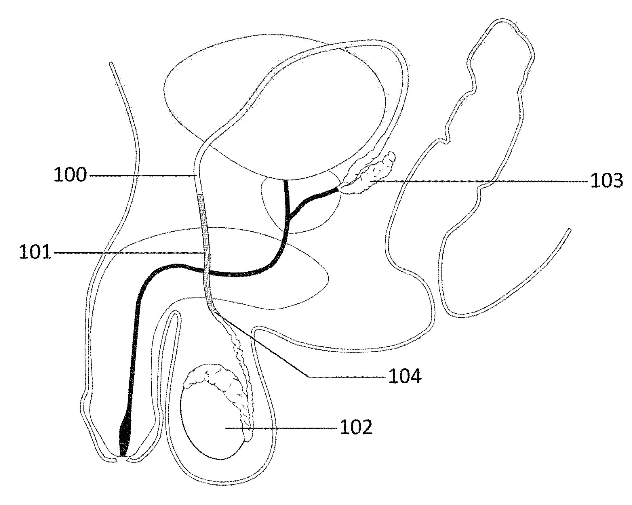 Compositions and methods relating to an occlusive polymer hydrogel