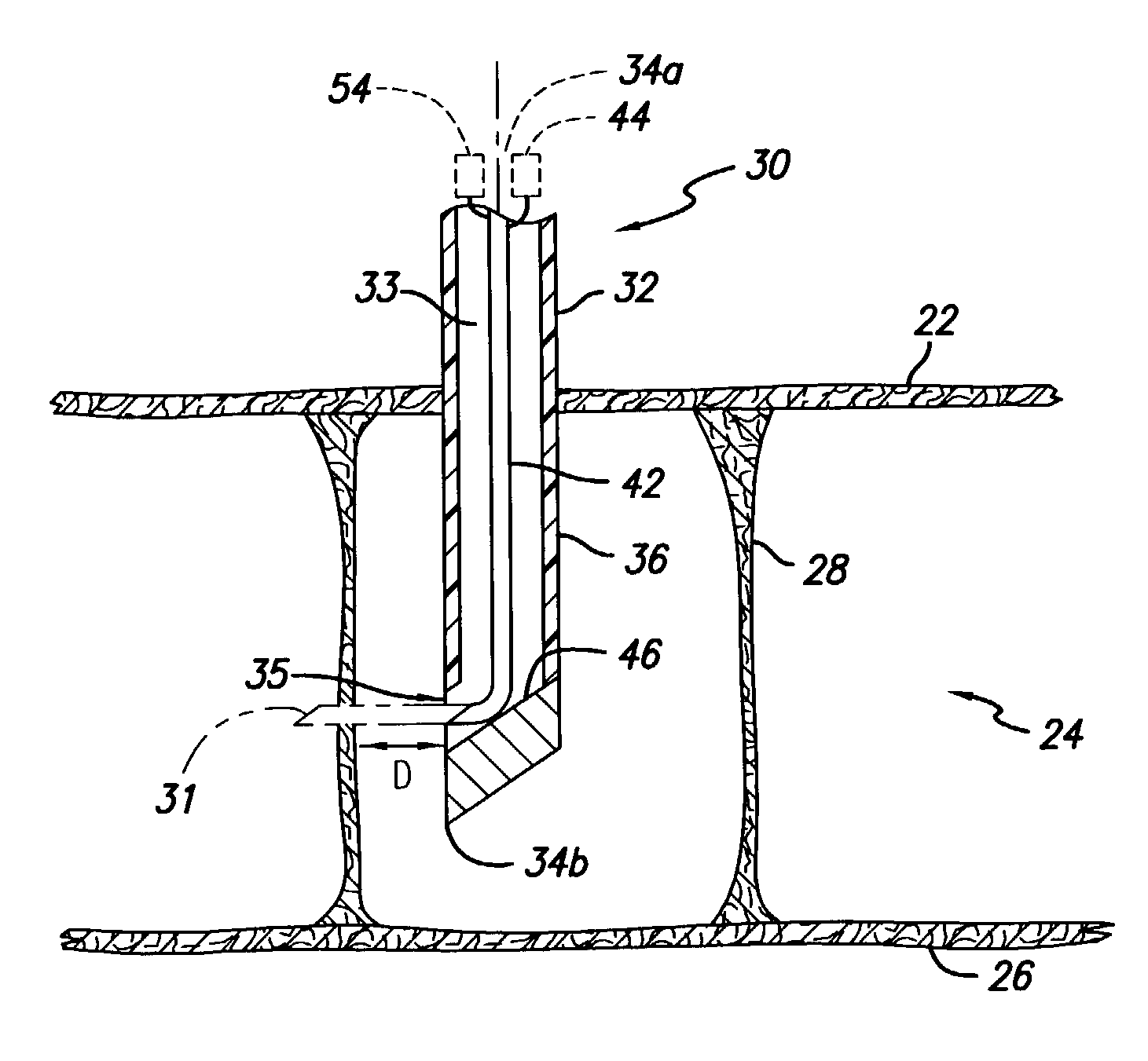 Percutaneous cellulite removal system