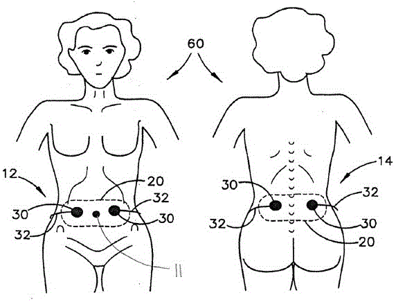 Transdermal stimulation methods and systems