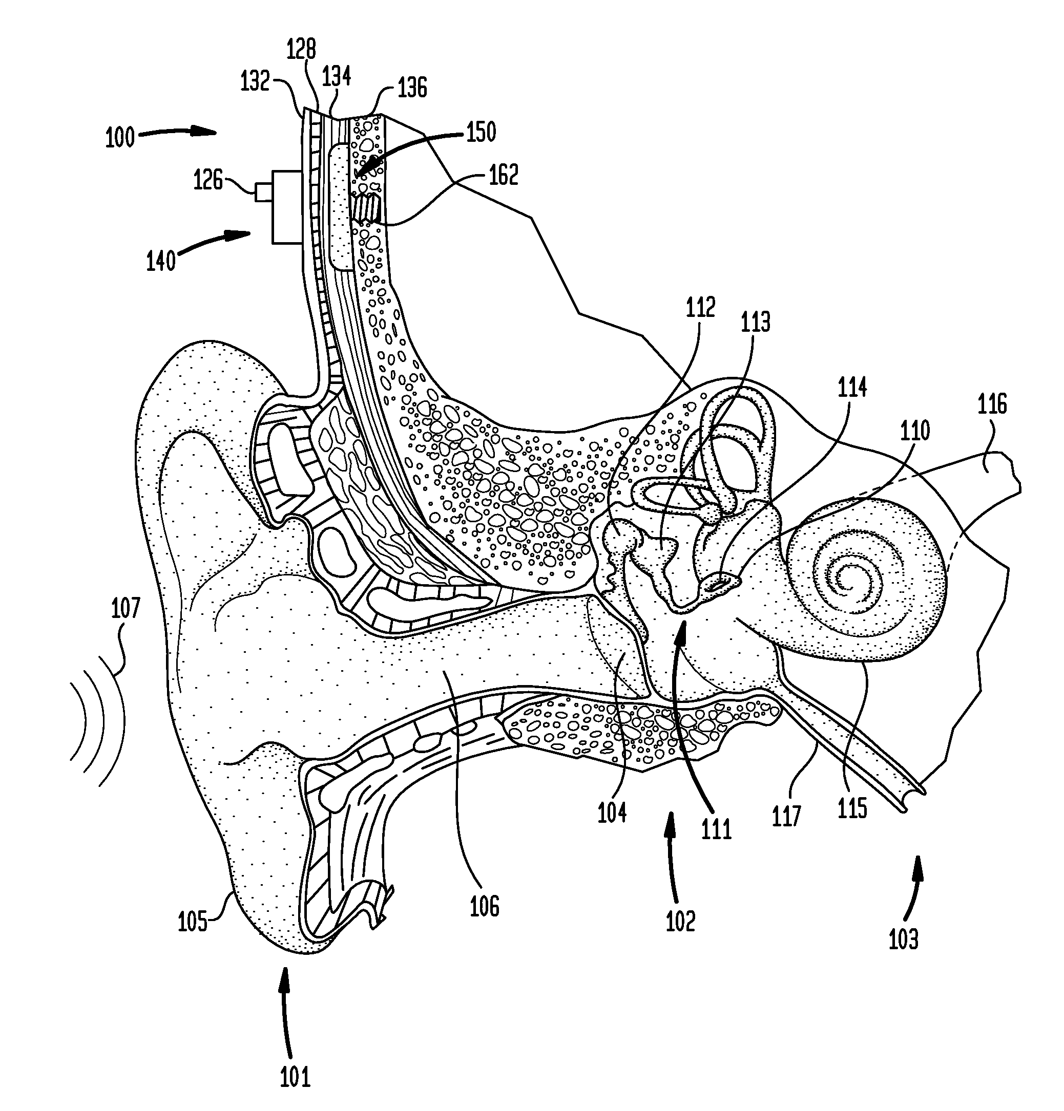 Vibration isolation in a bone conduction device