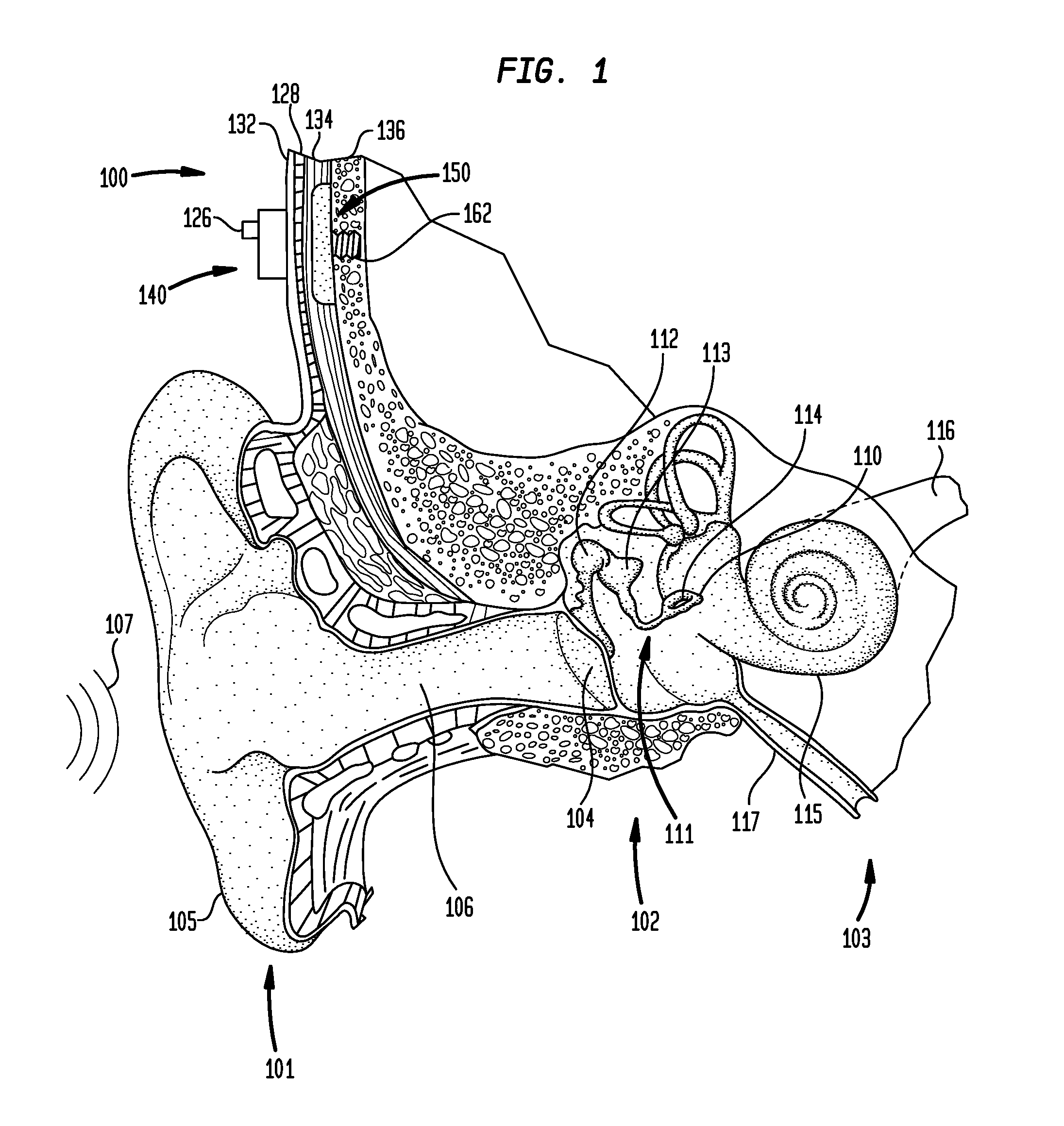 Vibration isolation in a bone conduction device