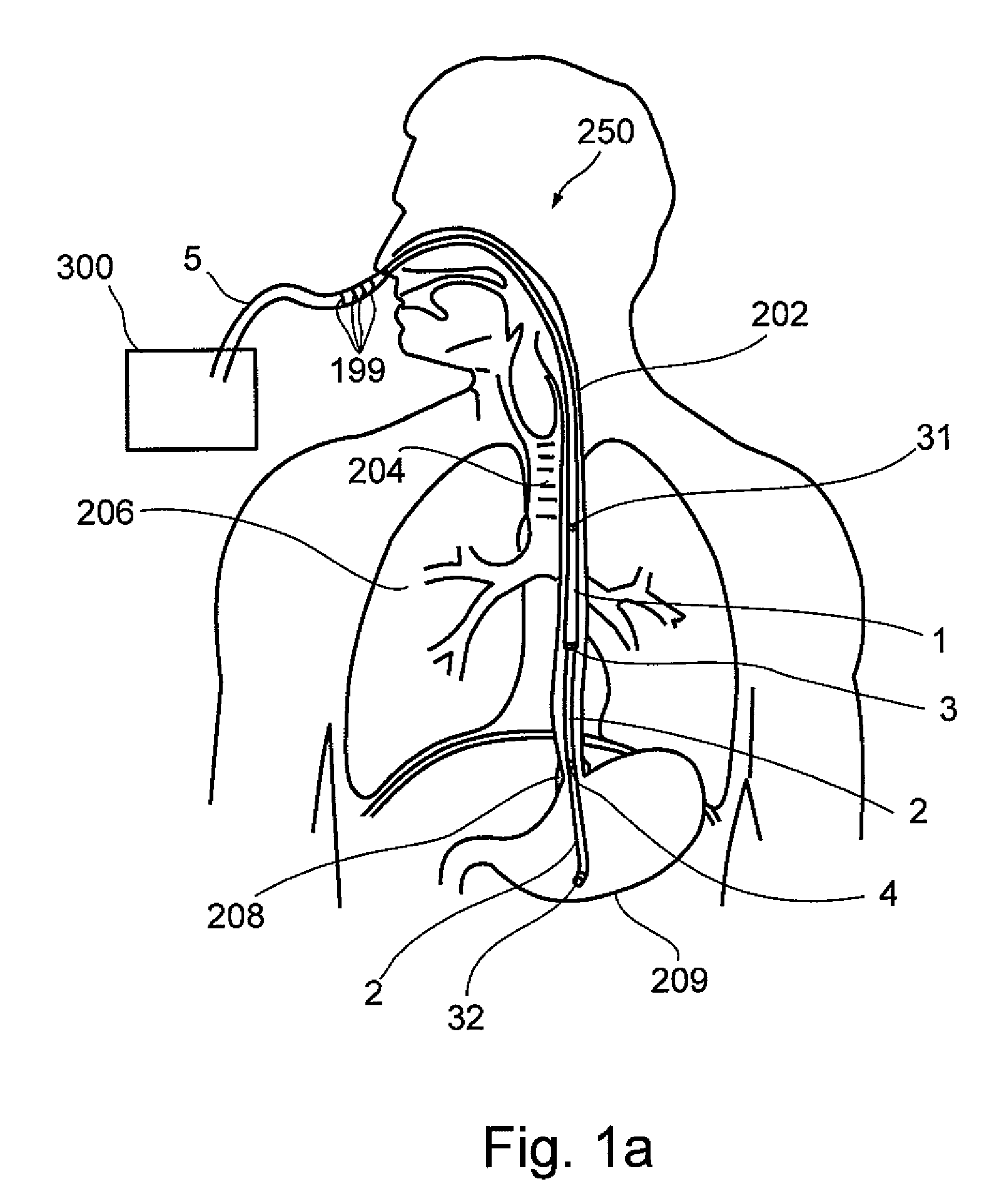 Interactive ngt system