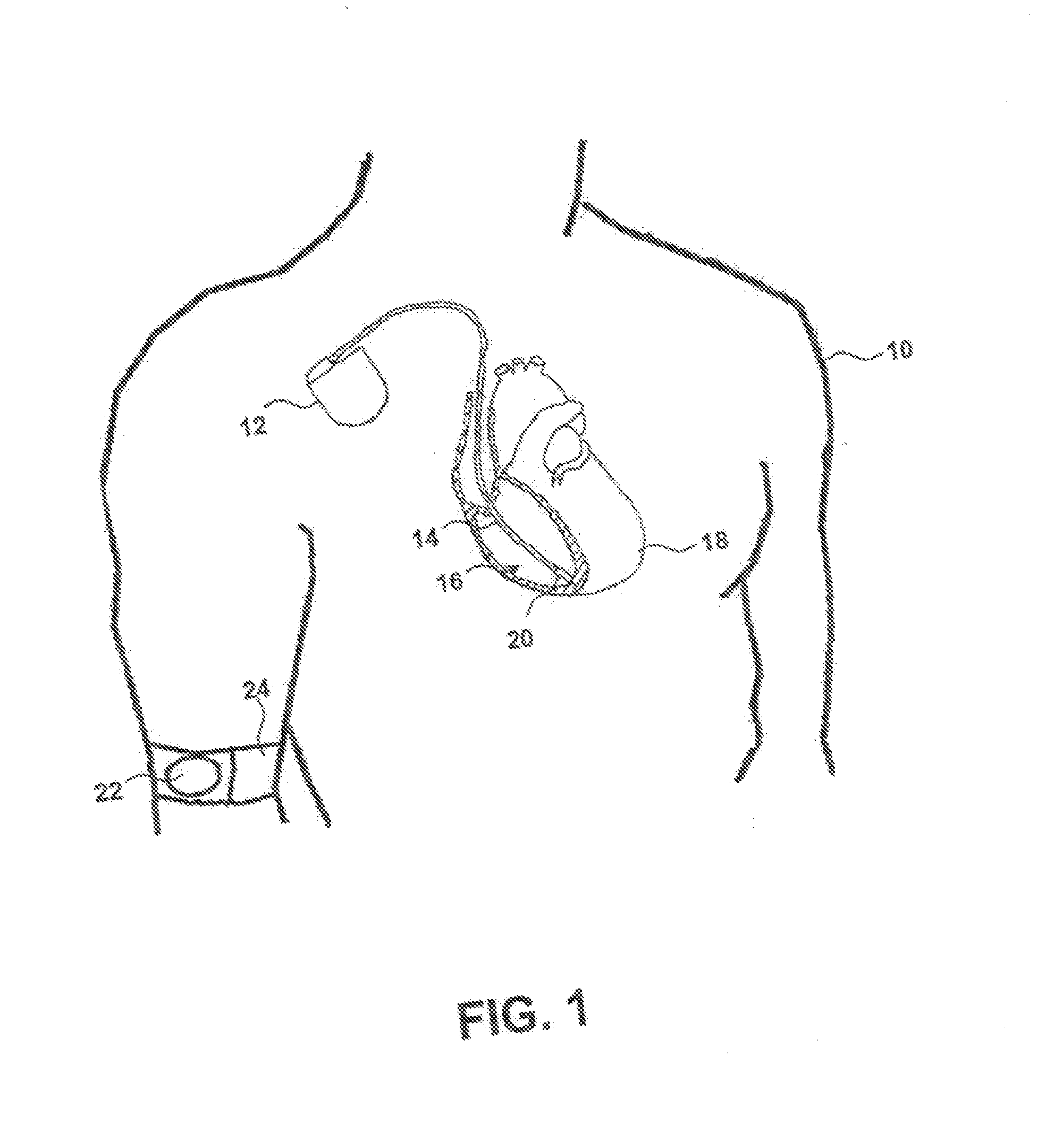 Fault tolerant sensors and methods for implementing fault tolerance in implantable medical devices