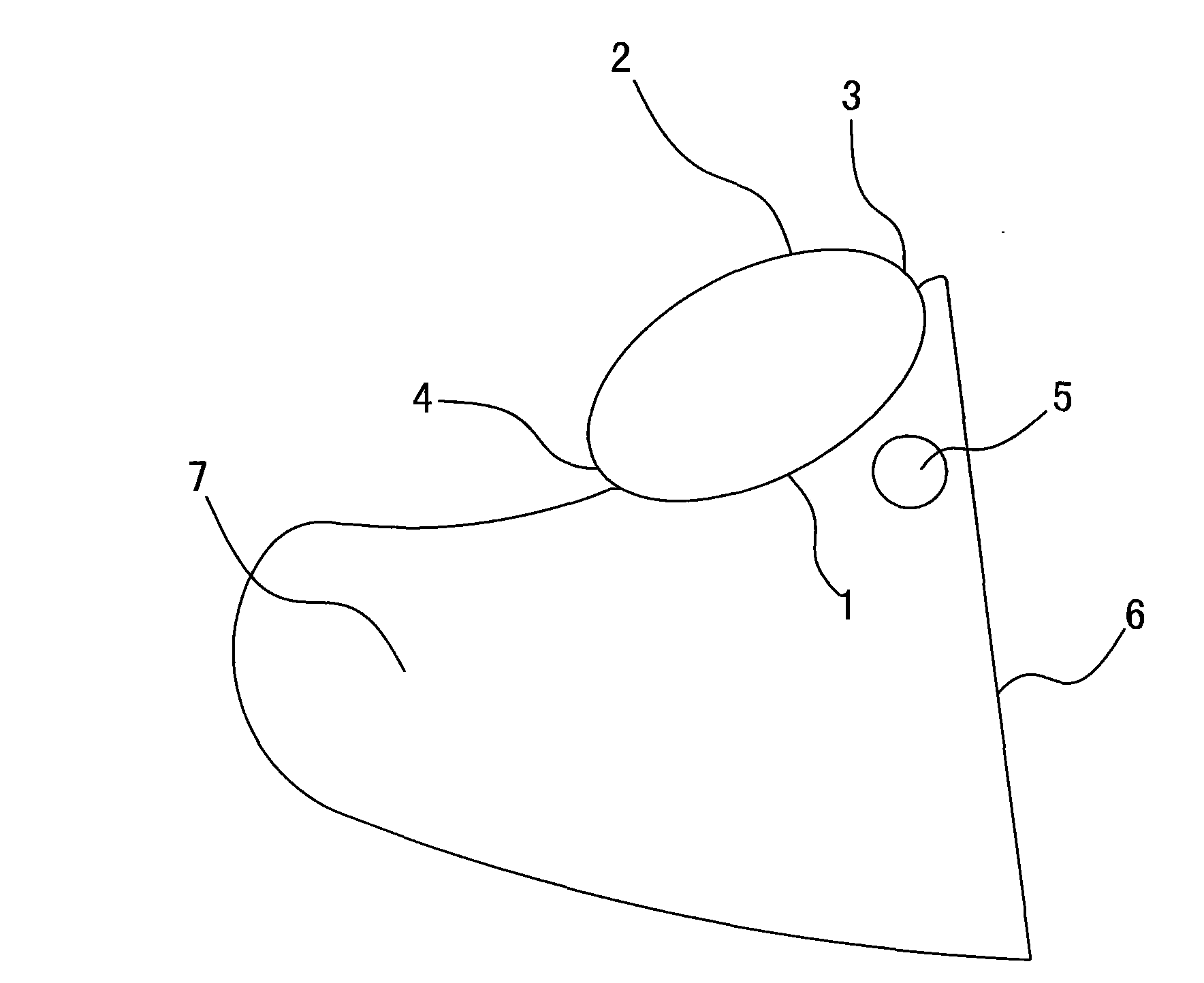 Prosthesis of posterior wall of external auditory canal