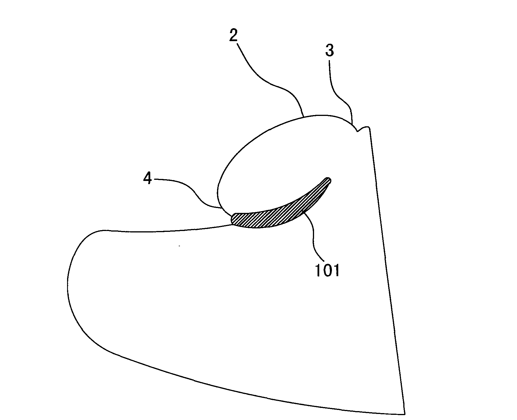 Prosthesis of posterior wall of external auditory canal