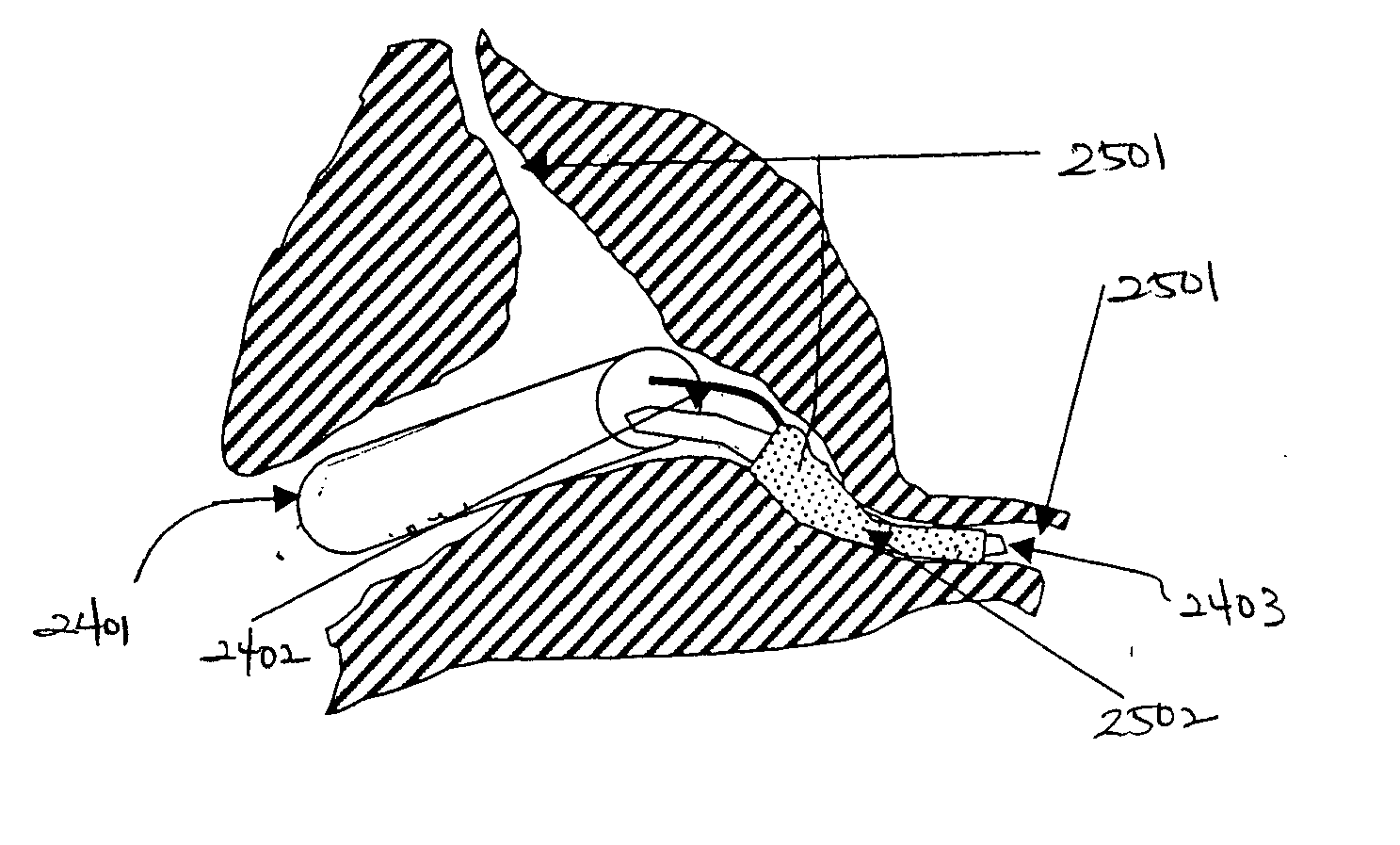 Encapsulation device and methods of use