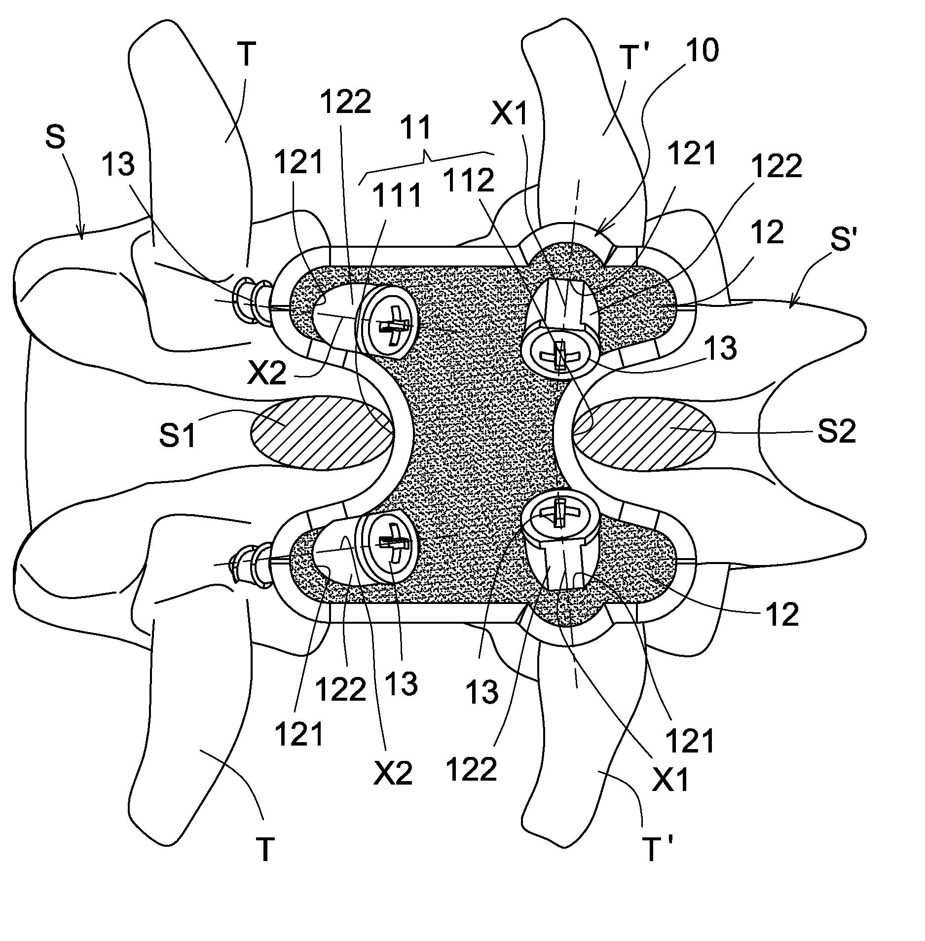 Vertebral fixation apparatus