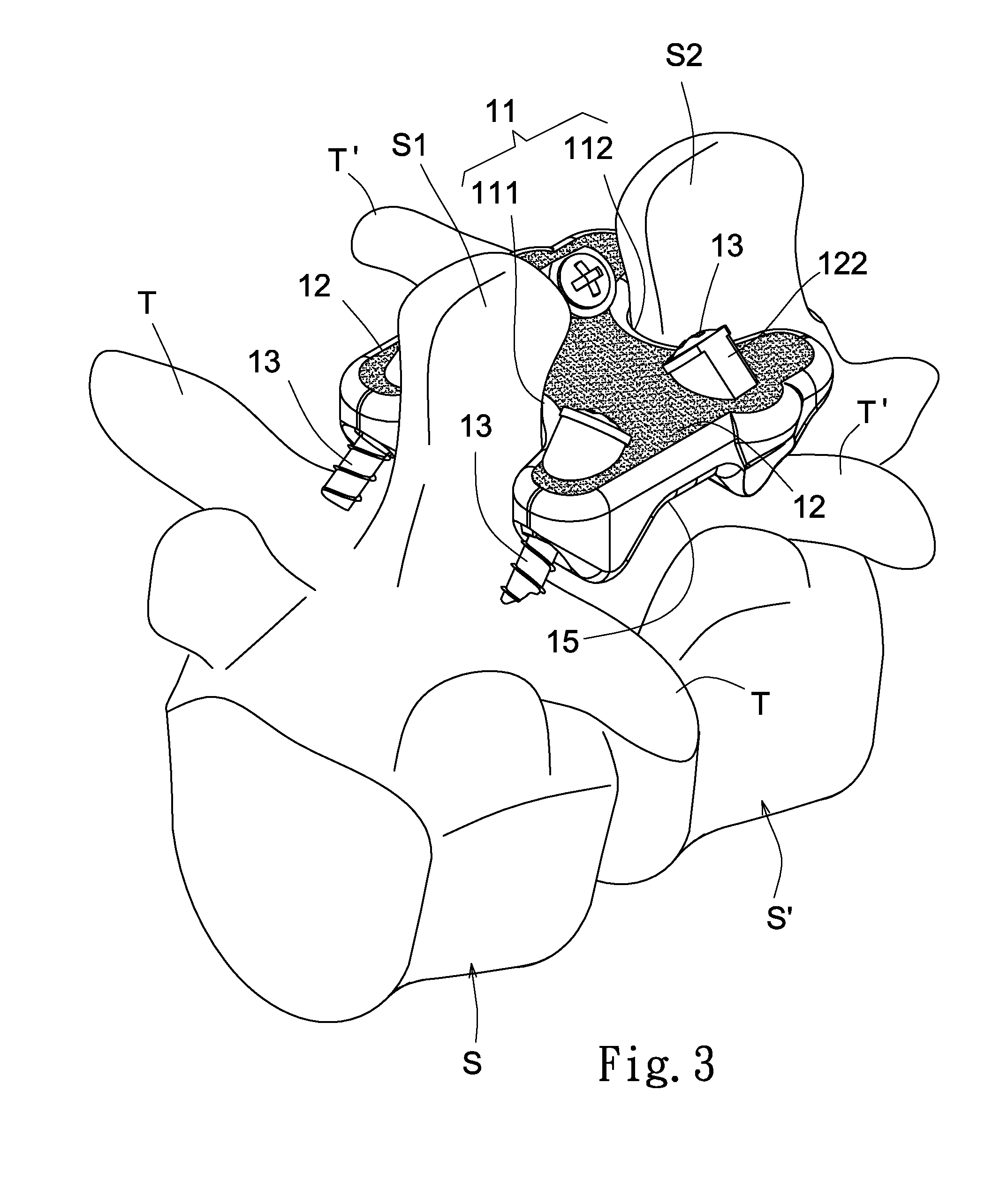 Vertebral fixation apparatus