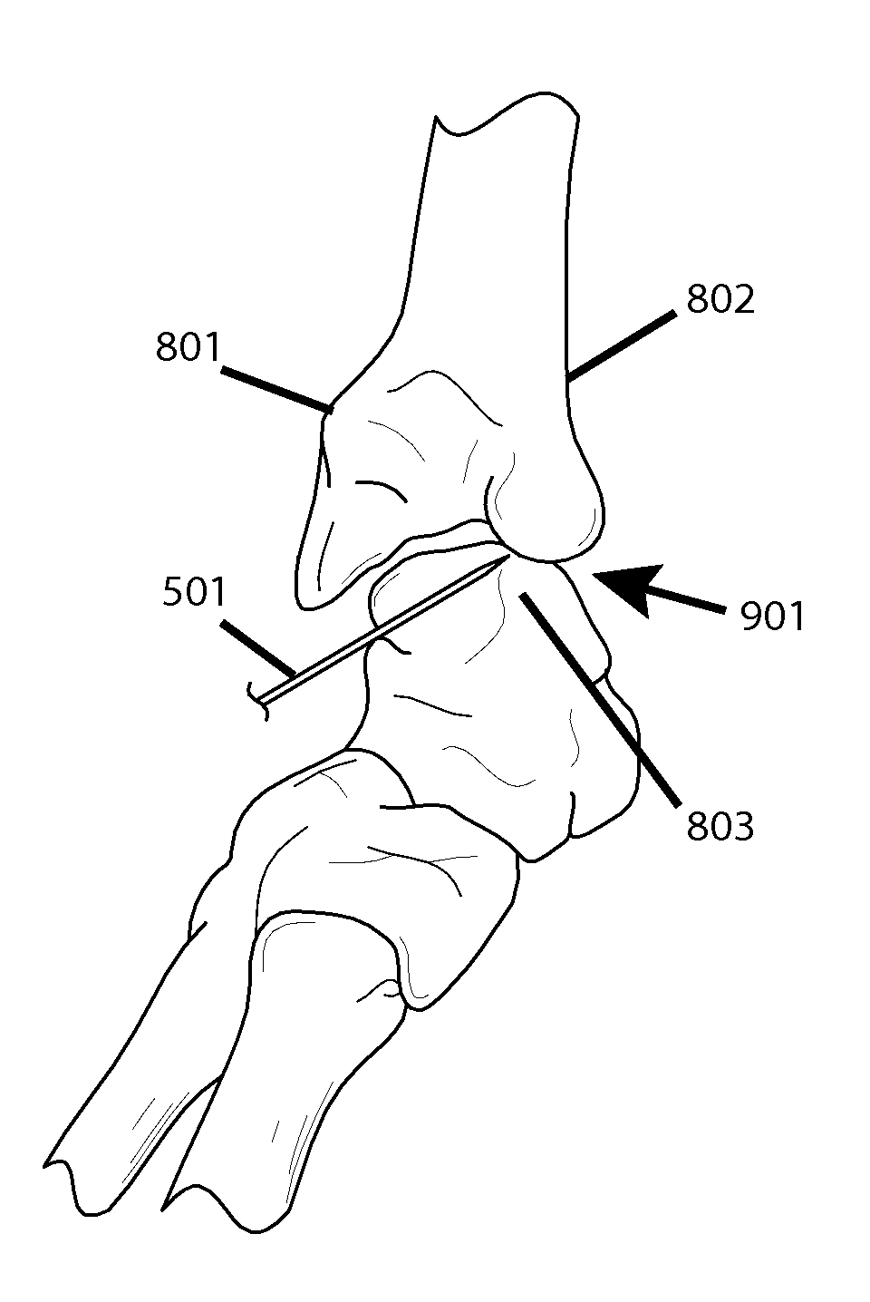 Arthroscopic joint surgery device and method of use