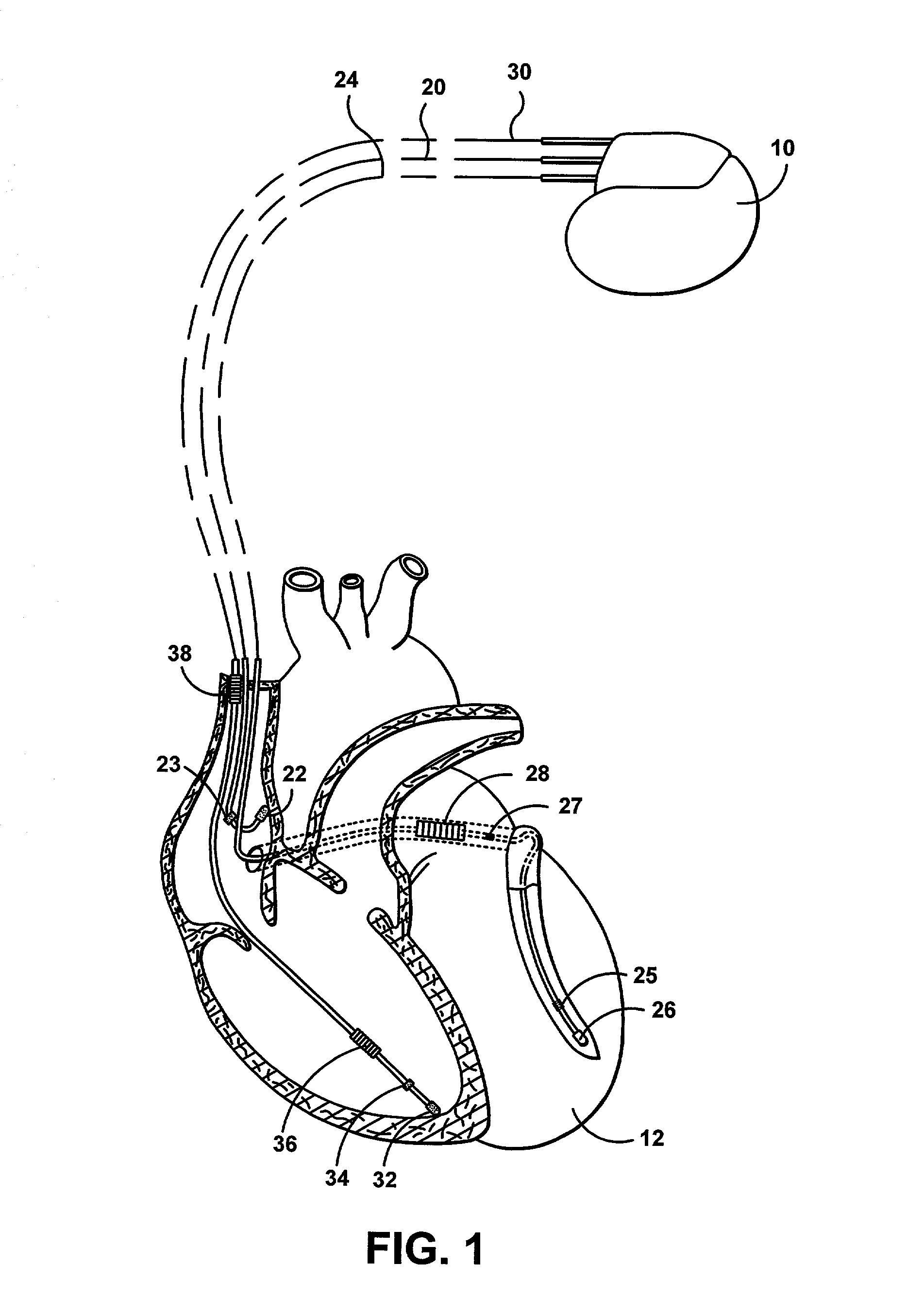 Method and apparatus for monitoring sensor performance during rate-responsive cardiac stimulation