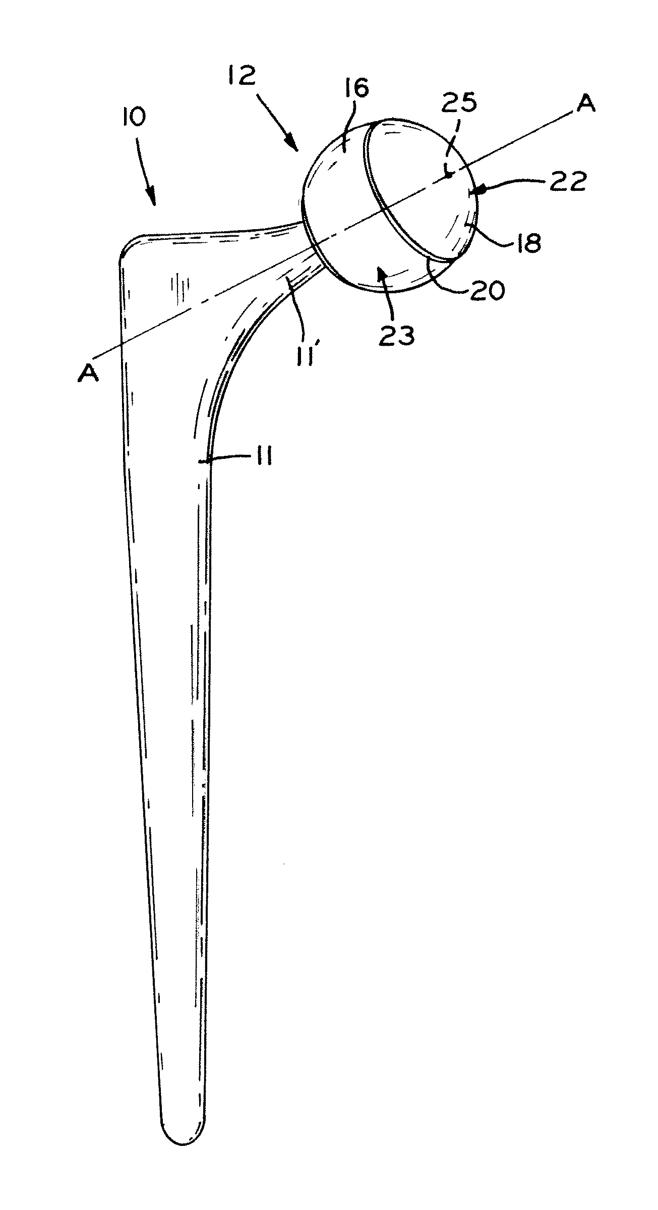 Bi-material prosthesis component