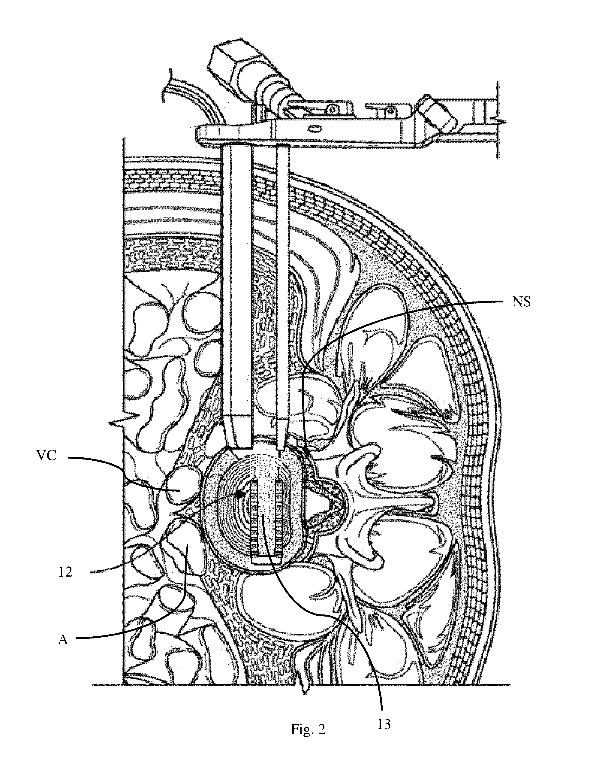 Interbody fusion implant and related methods