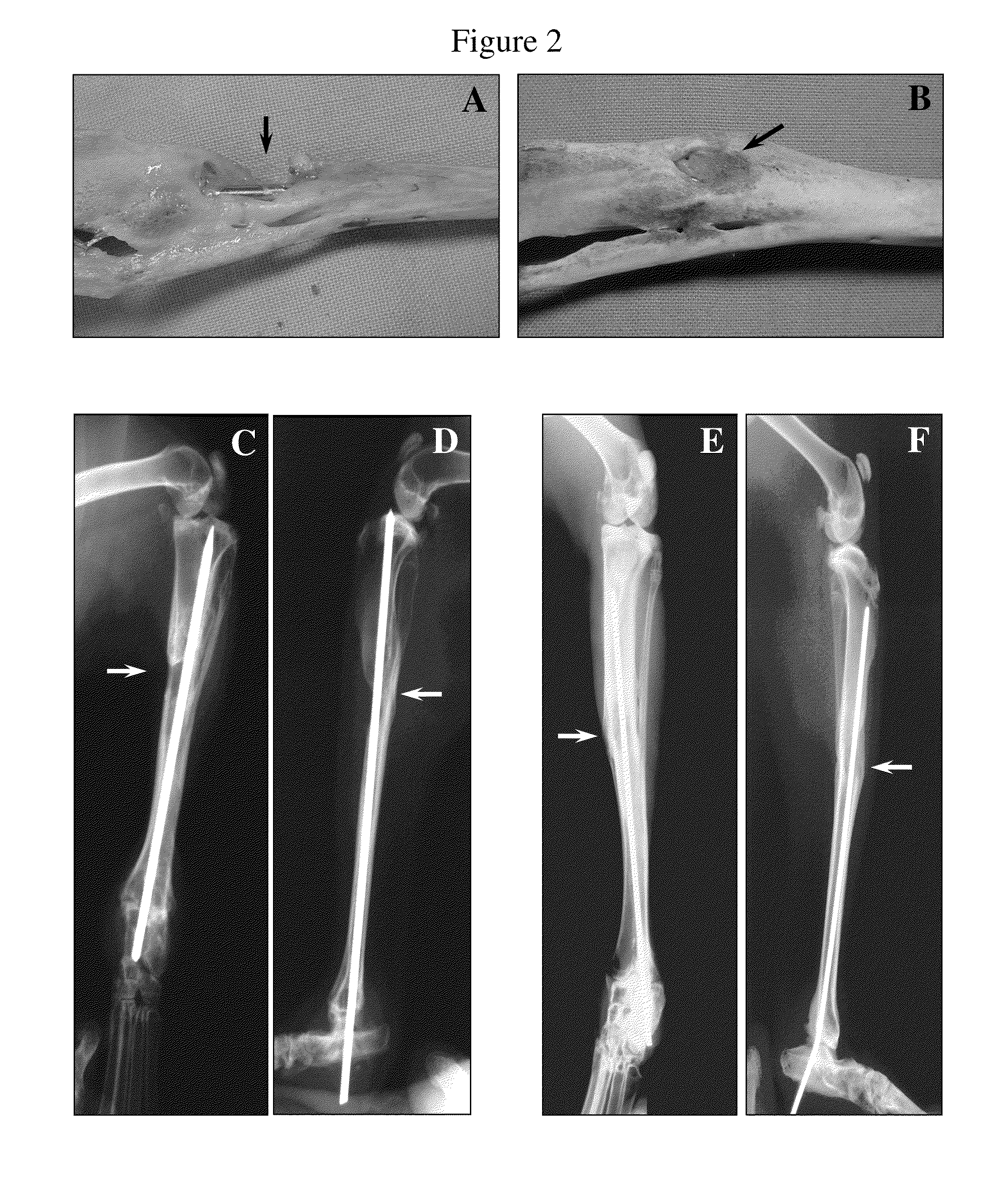 Method for healing bone fracture using transfected chondrocytes