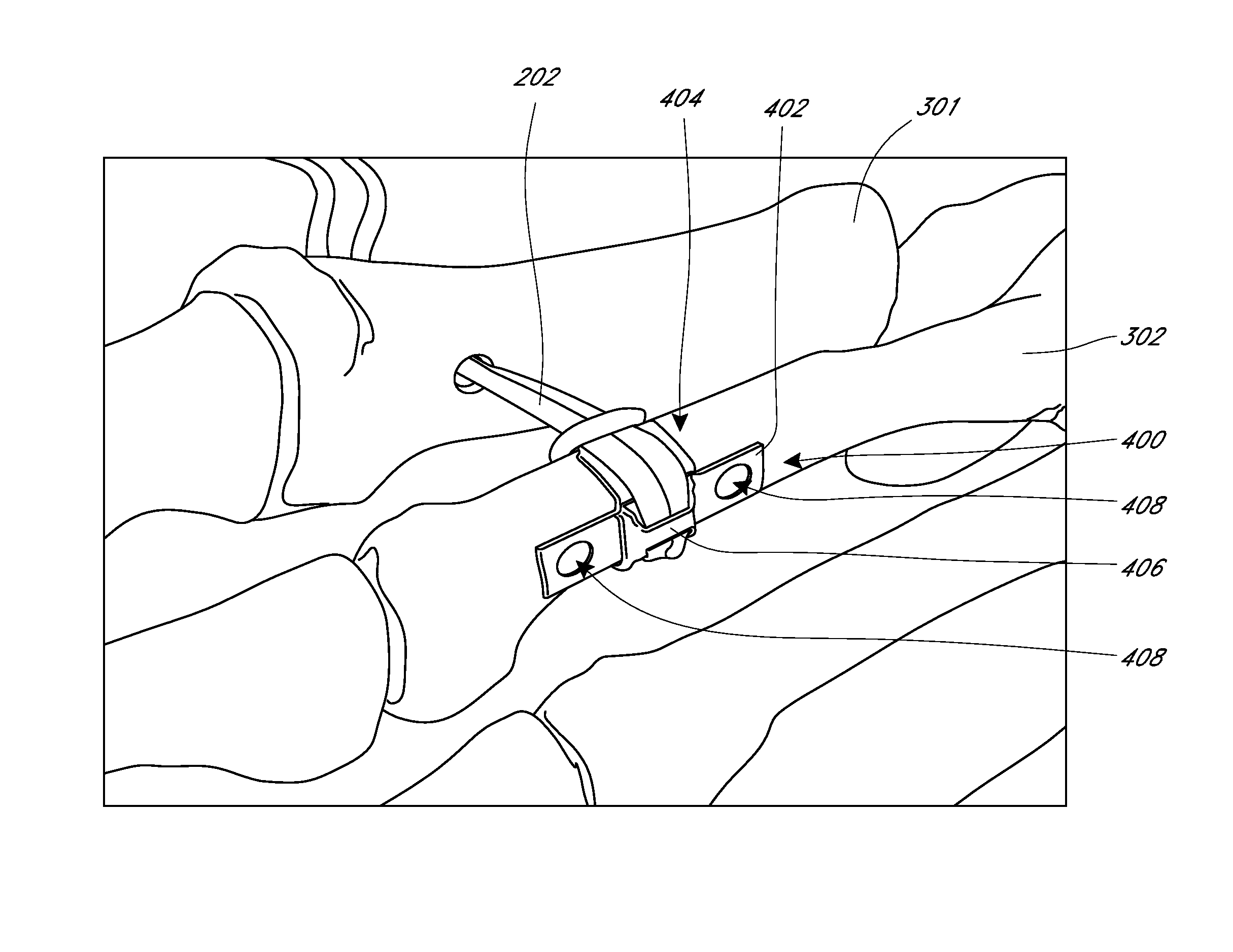 Bone plate for reducing angular bone deformity and method of using