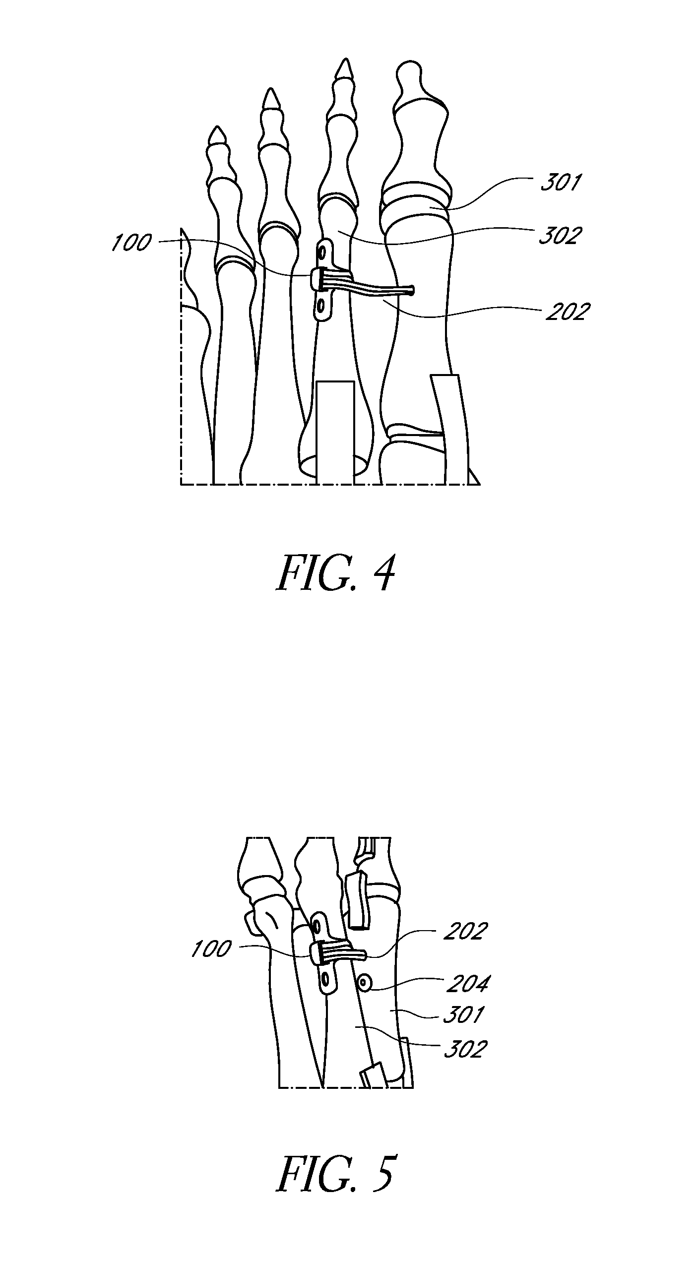 Bone plate for reducing angular bone deformity and method of using