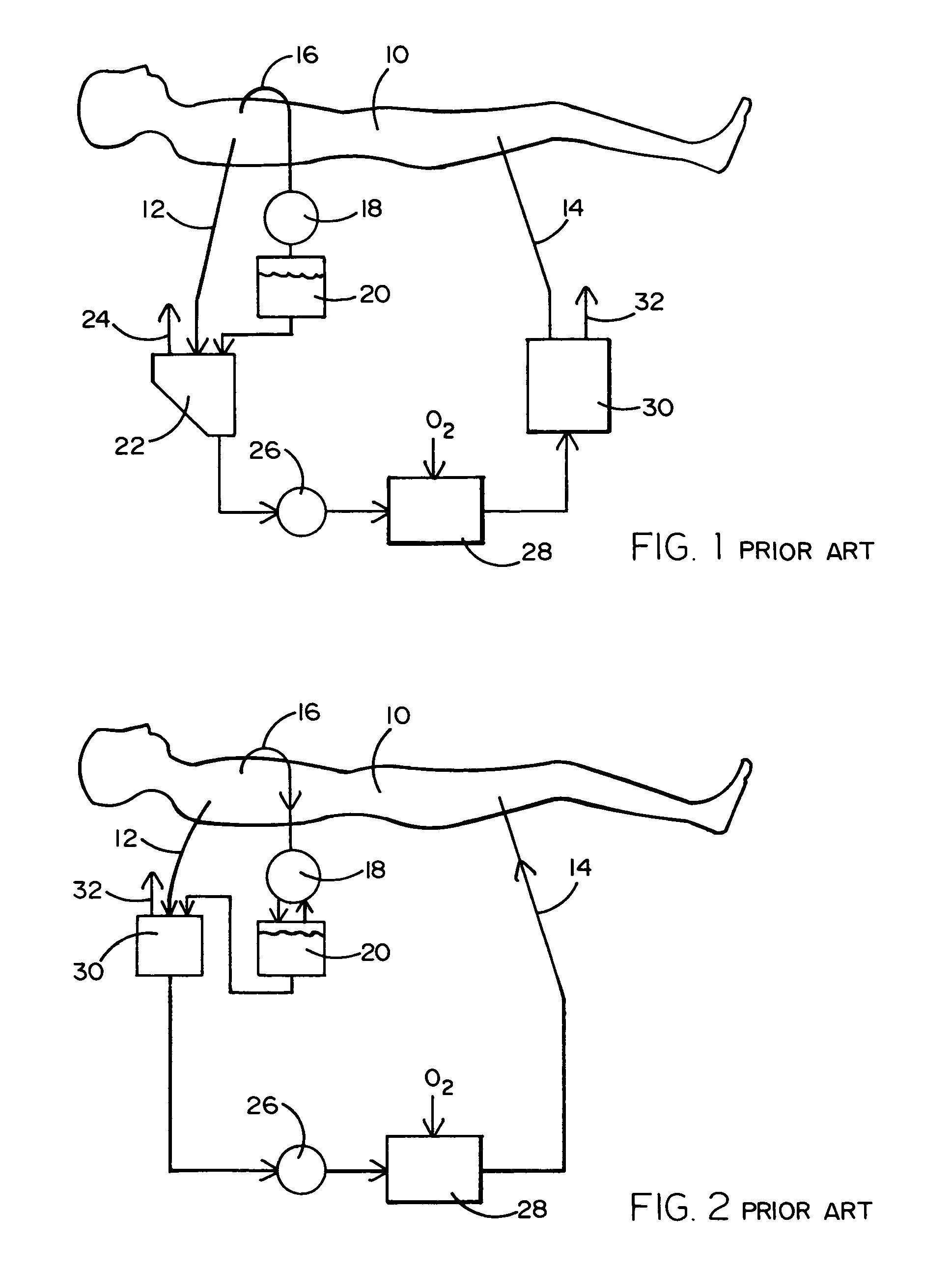 Venous filter for assisted venous return