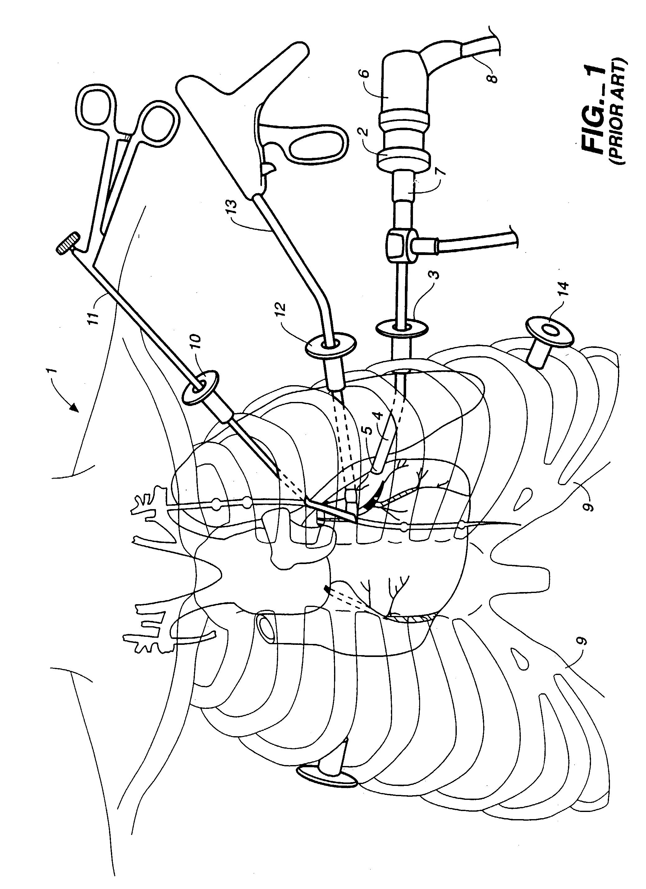 Visualization during closed-chest surgery