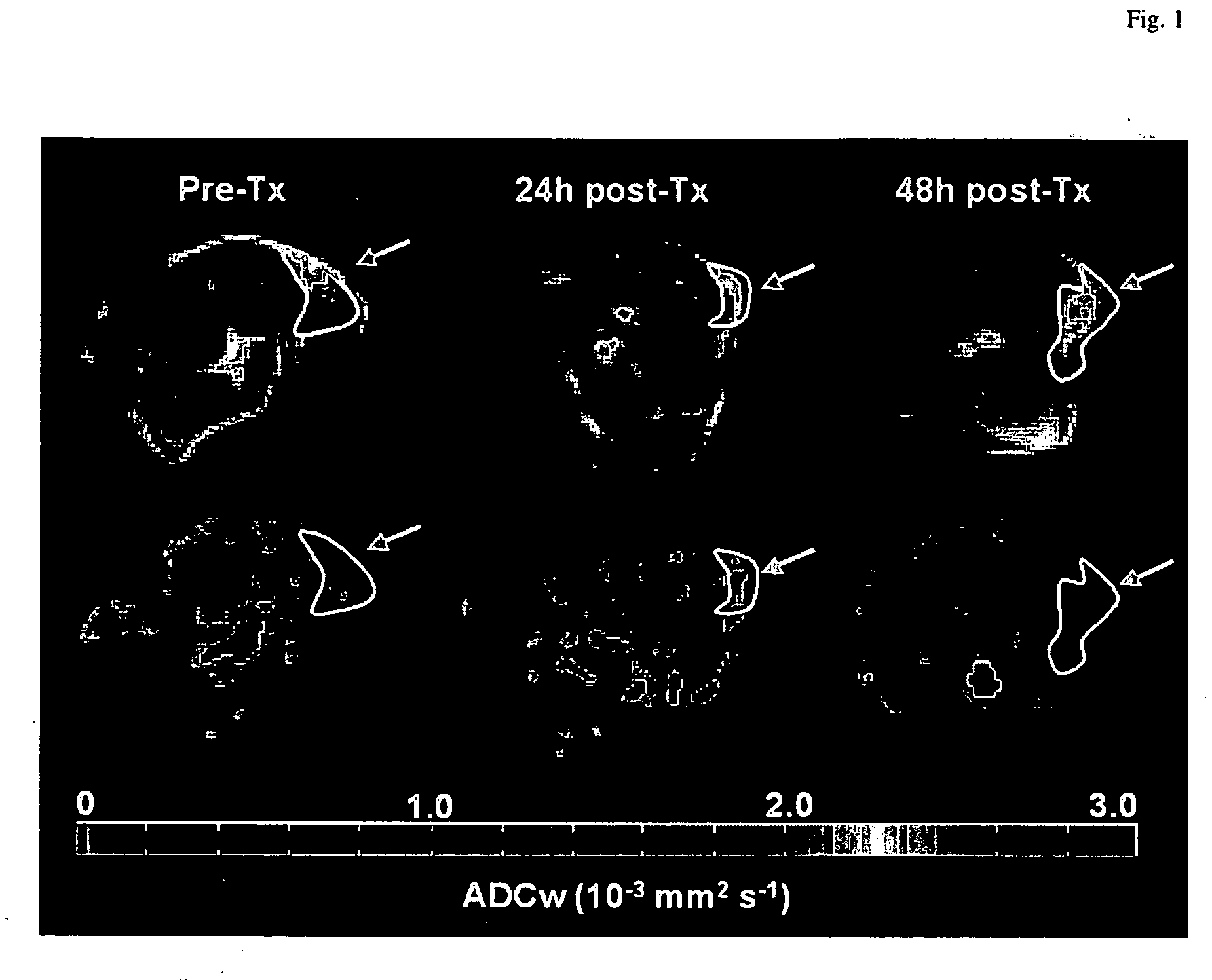 Method of preselection patients for anti-VEGF, anti-HIF-1 or anti-thioredoxin therapy