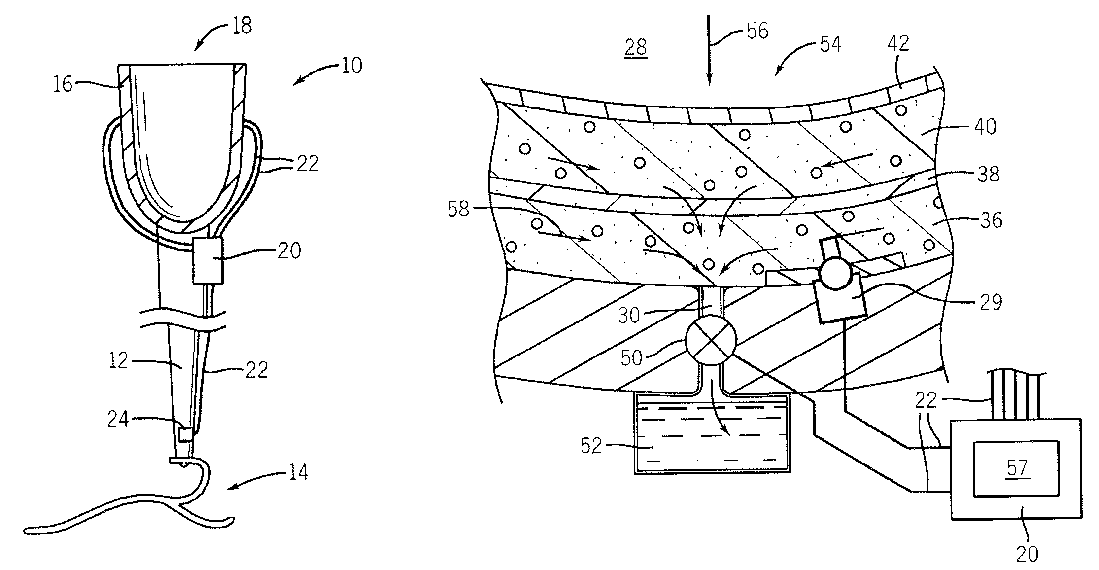 Prosthetic socket with real-time dynamic control of pressure points