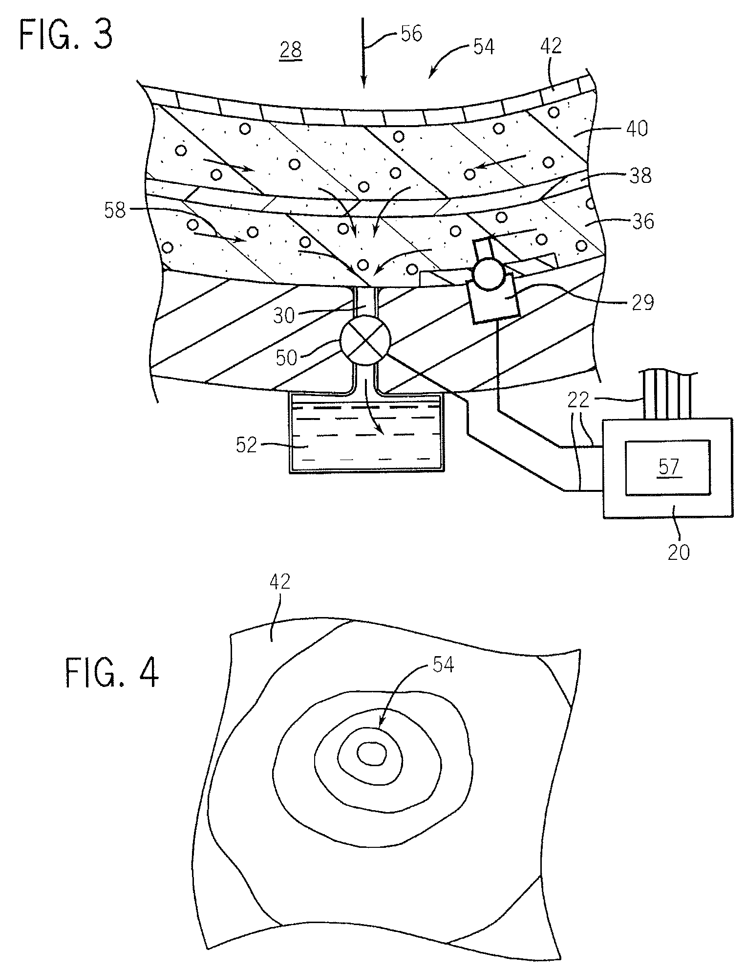 Prosthetic socket with real-time dynamic control of pressure points