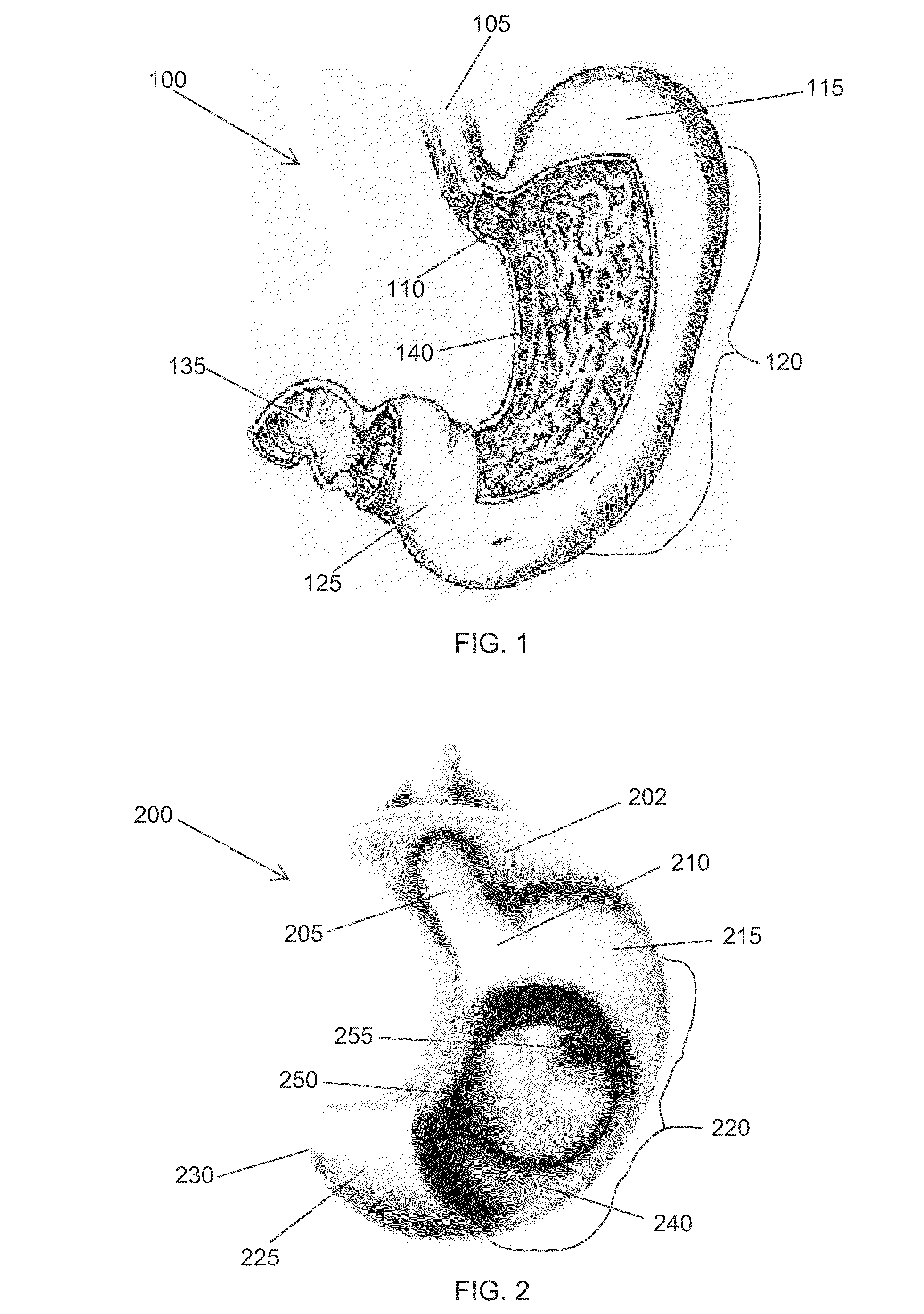 High specific gravity intragastric device