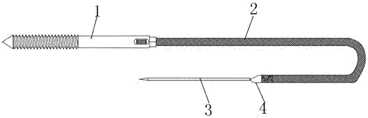 An integrated fixation device for olecranon fracture