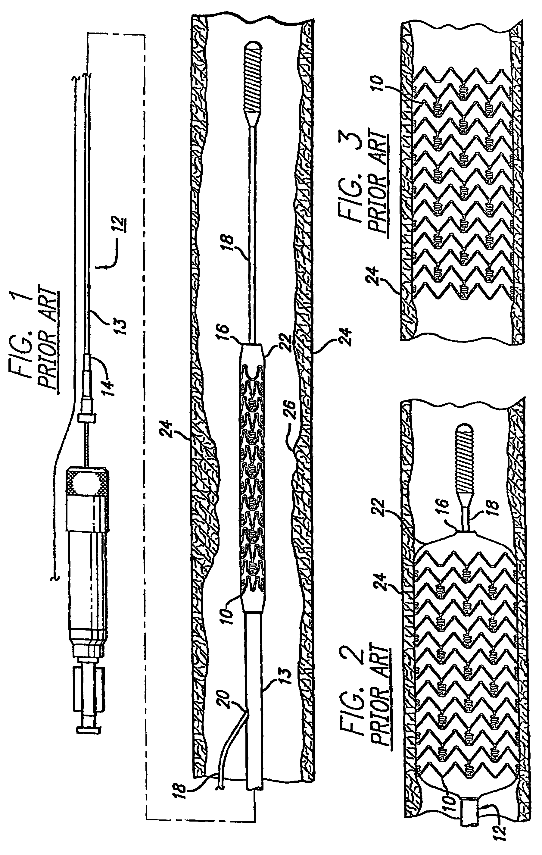 Intravascular stent