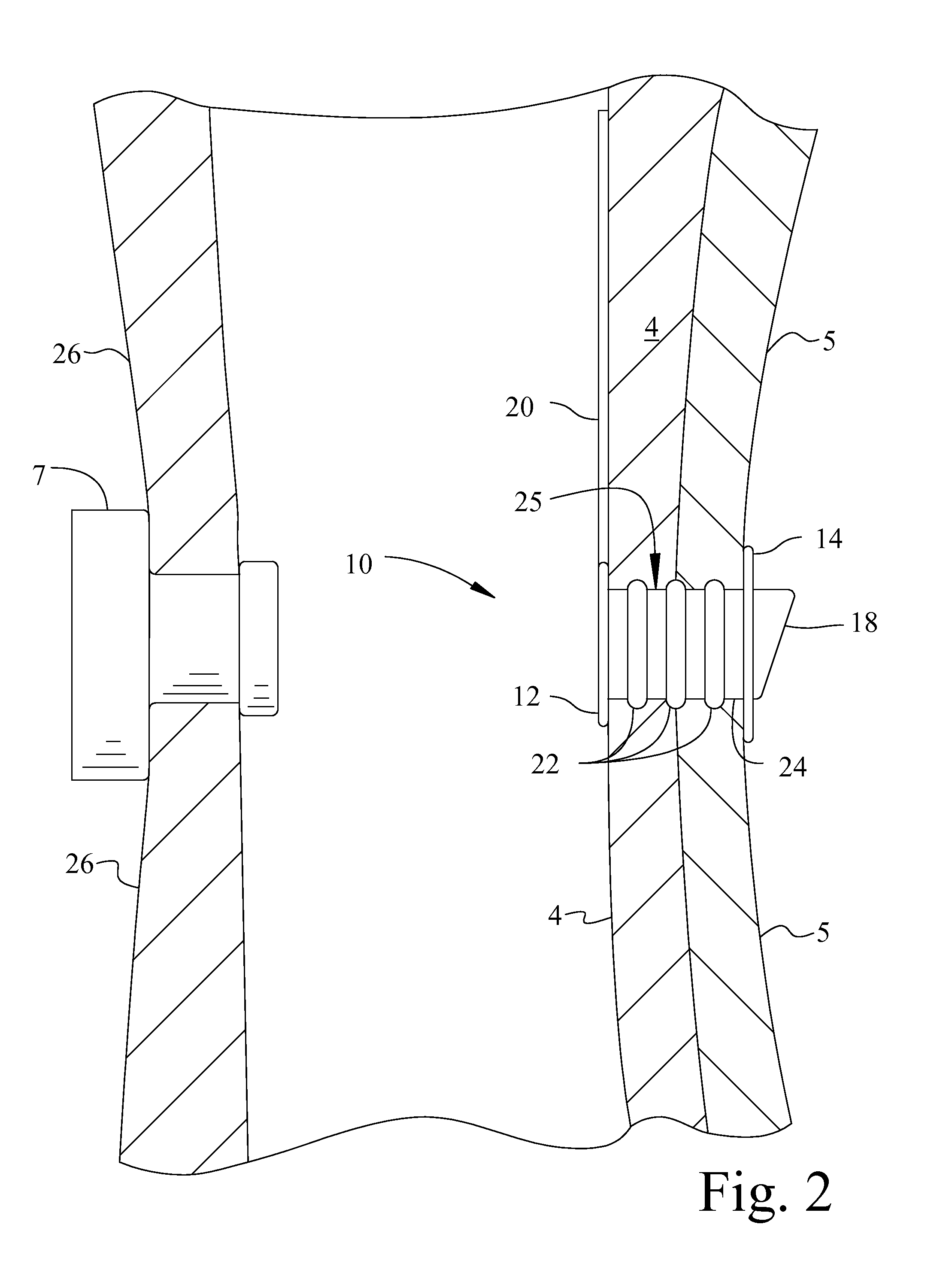 Voice Prosthesis